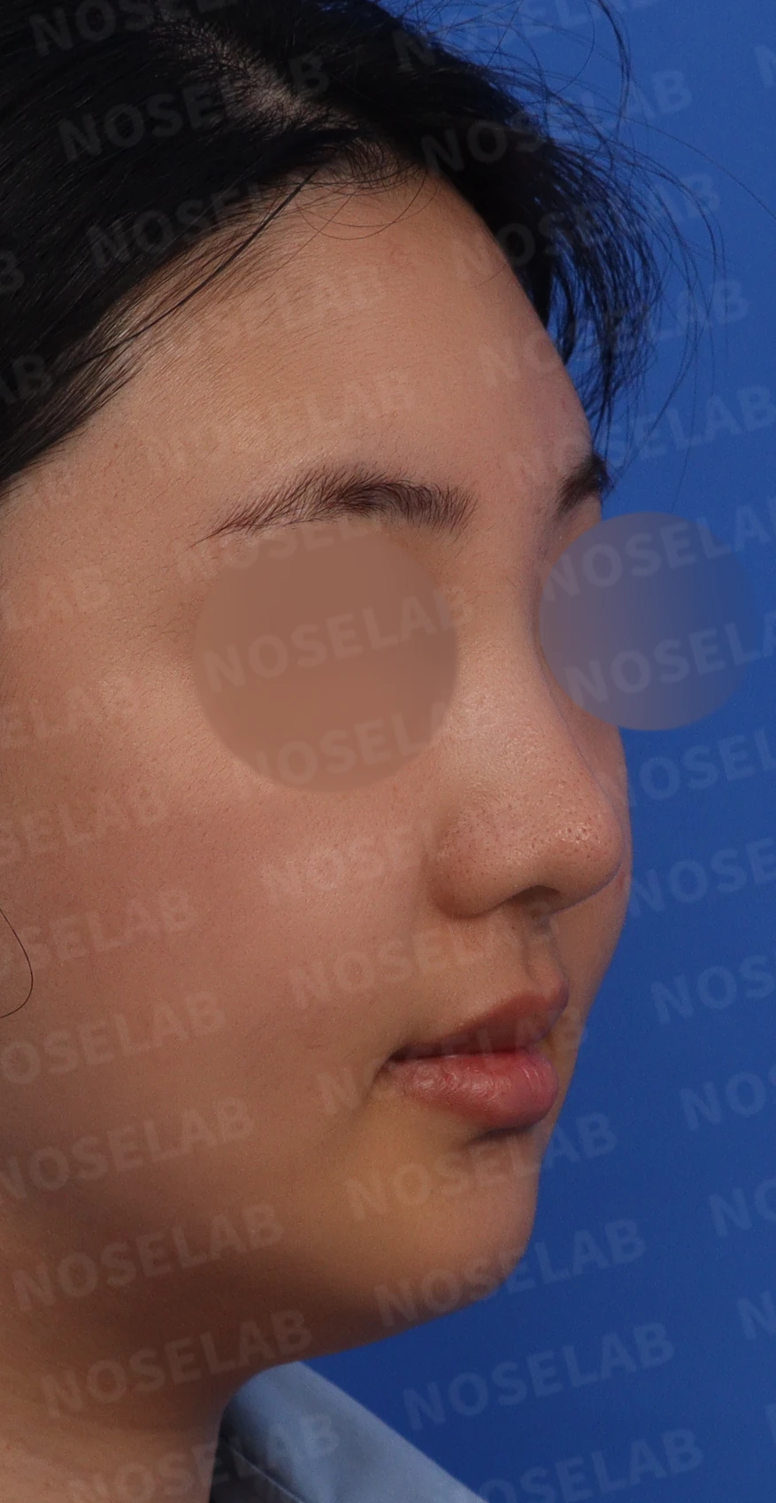 퍼진 코 개선과 콧구멍 비대칭 교정 방법 — 본문 사진 2