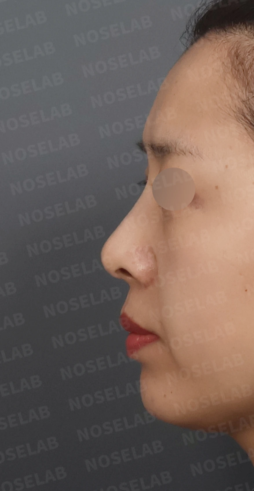 비공 비대칭과 휘어진 코, 자가늑연골 재건으로 교정한 코재수술 — 디자인 상담 정면, 좌측 측면, 비스듬한 측면 사진