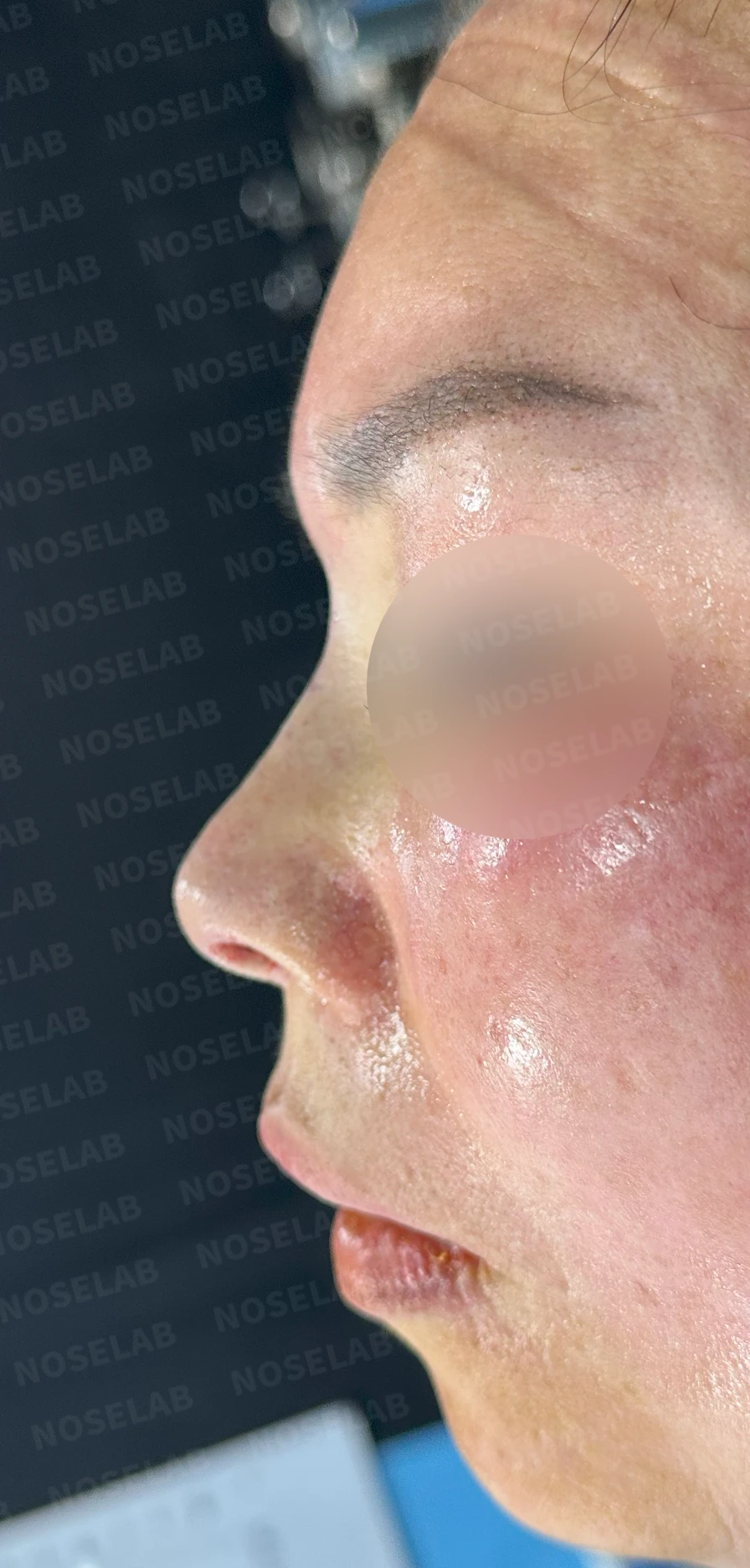 불법 주사 시술 뒤 코가 들리고 짧아지는 이유, 이물질 제거와 재건은 어떻게 하나 — 수술 직후 0일 정면, 측면, 비스듬한 측면 사진 직후 사진은 부기가 있는 상태로 최종 결과와 다를 수 있습니다.