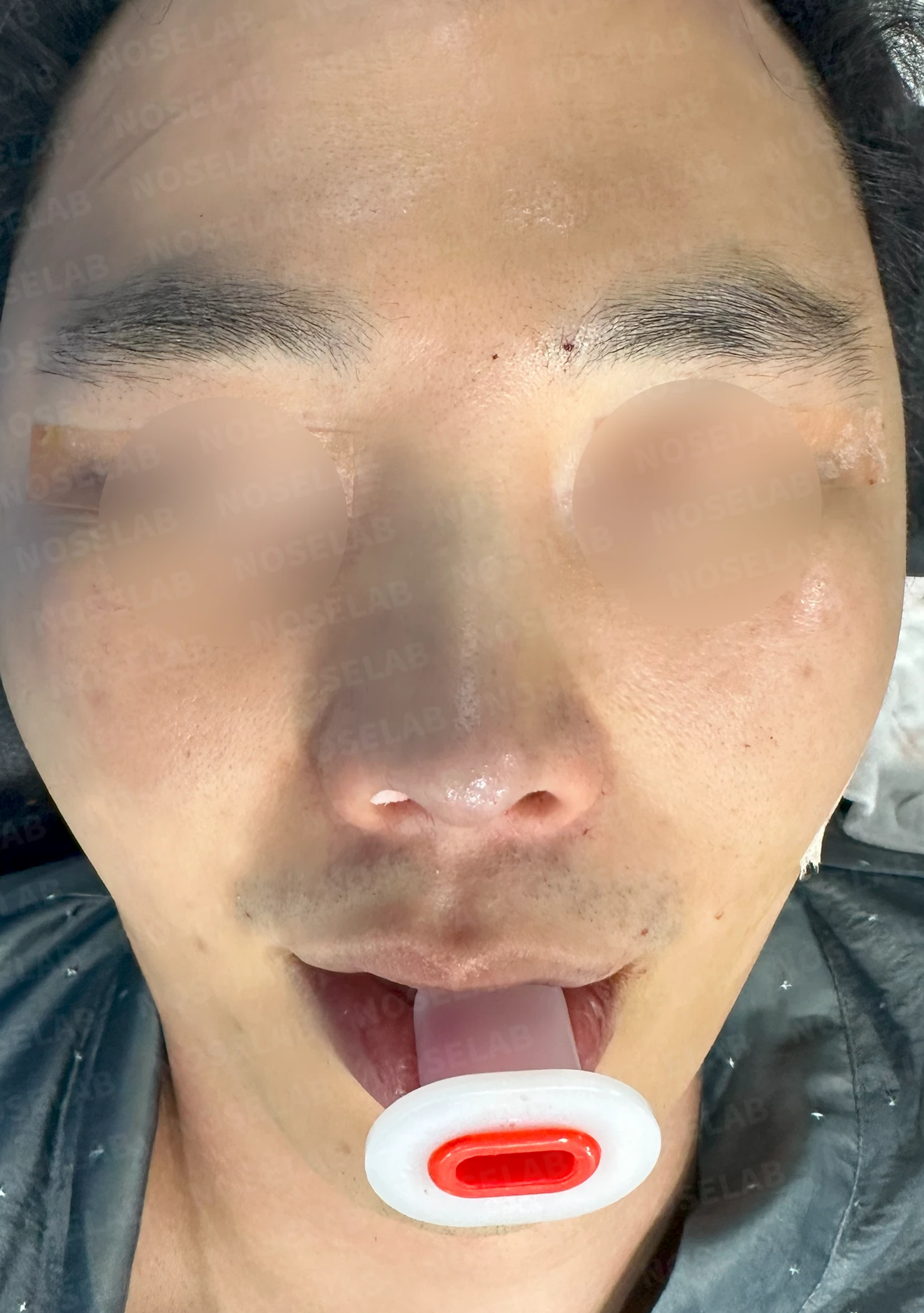 비중격 연골을 많이 쓴 코가 들리고 막히는 이유, 재건은 어떻게 하나 — 수술 전 / 수술 직후 0일 직후 사진은 부기가 있는 상태로 최종 결과와 다를 수 있습니다.