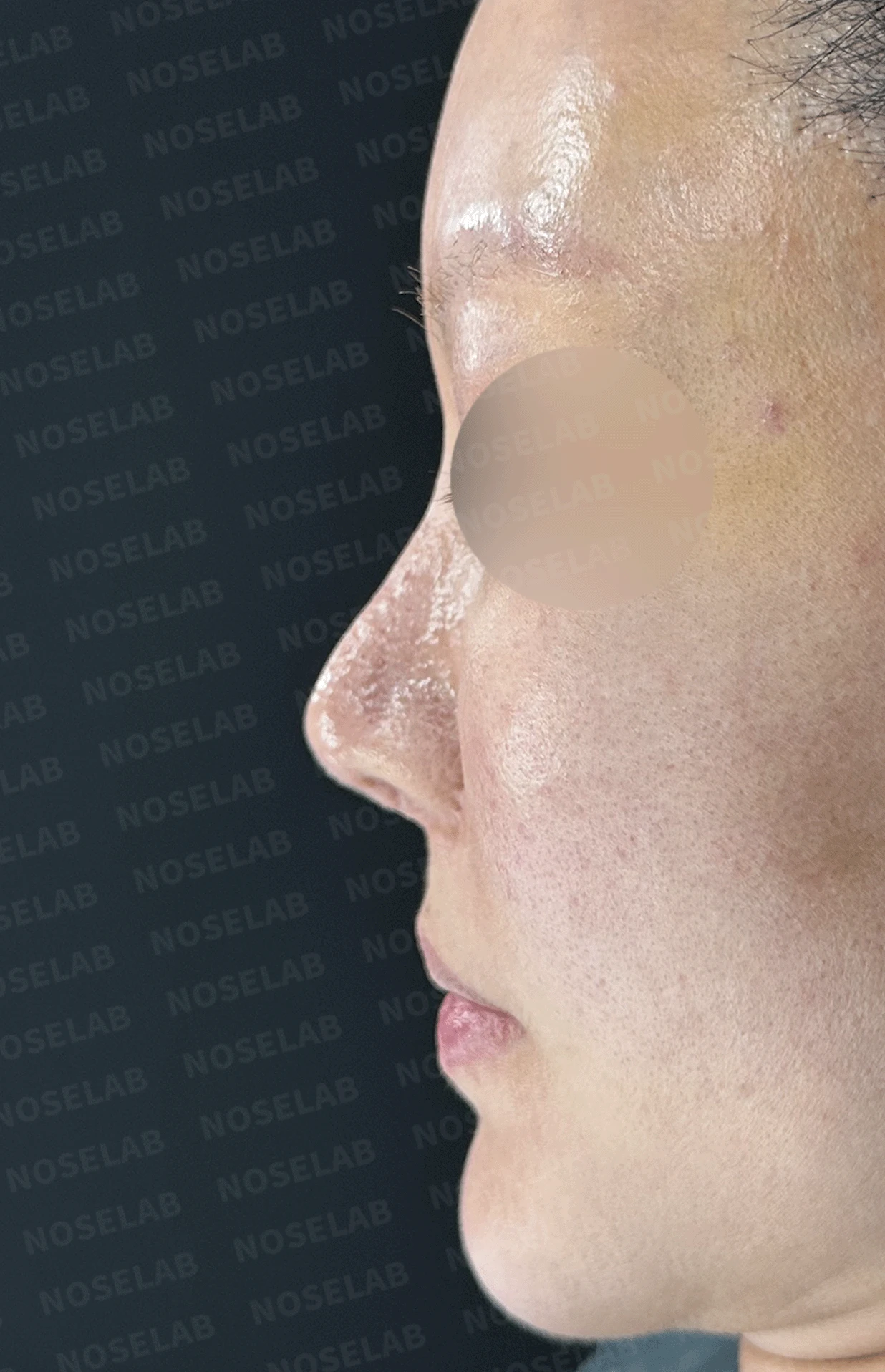 여러 차례 재수술로 코에 쓸 연골이 남지 않았을 때, 재건은 어떻게 하나 — 본문 사진 9