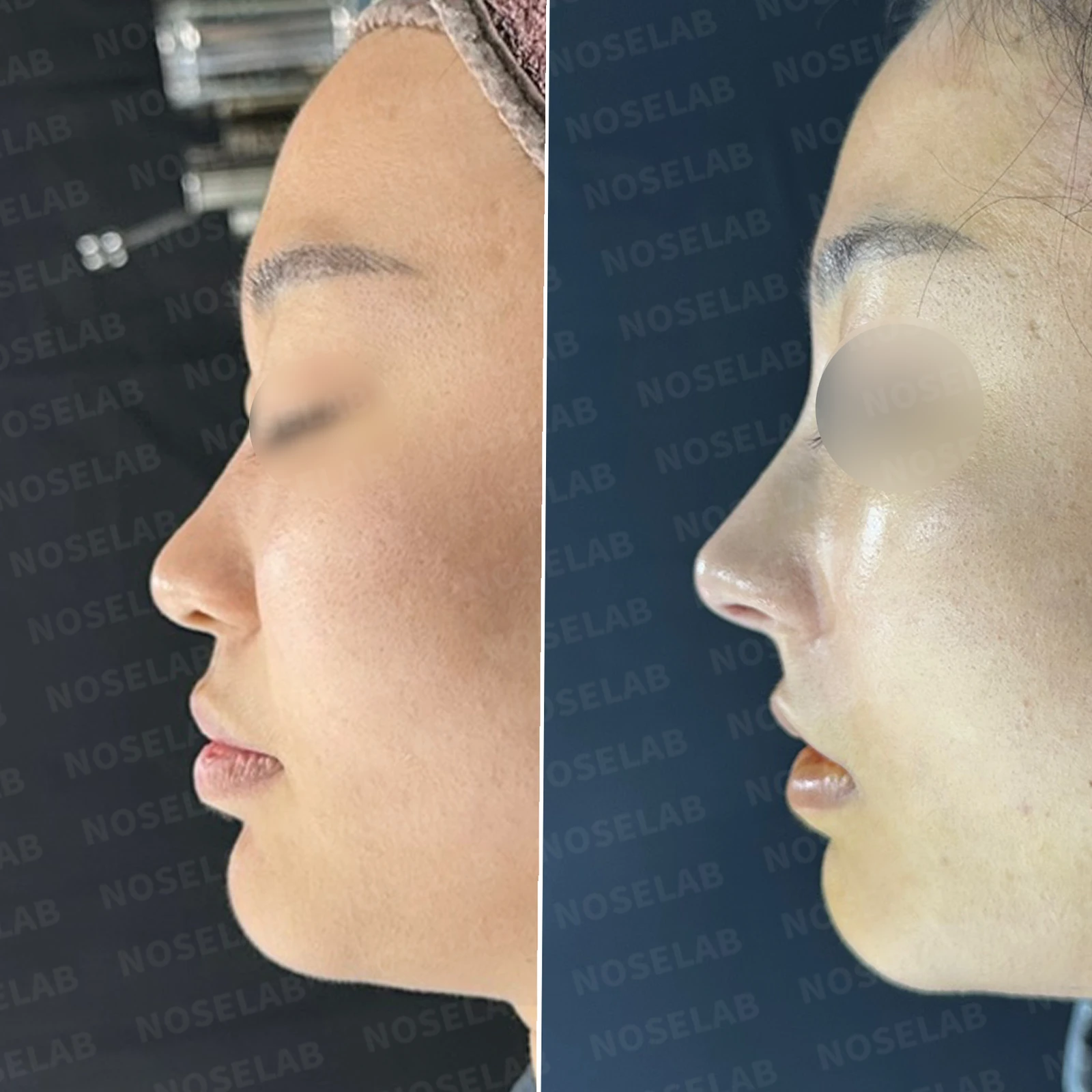 뭉툭하게 퍼진 코끝이 생기는 이유, 자가 늑연골 비중격 연장으로 직반 라인을 만드는 방법 — 본문 사진 22
