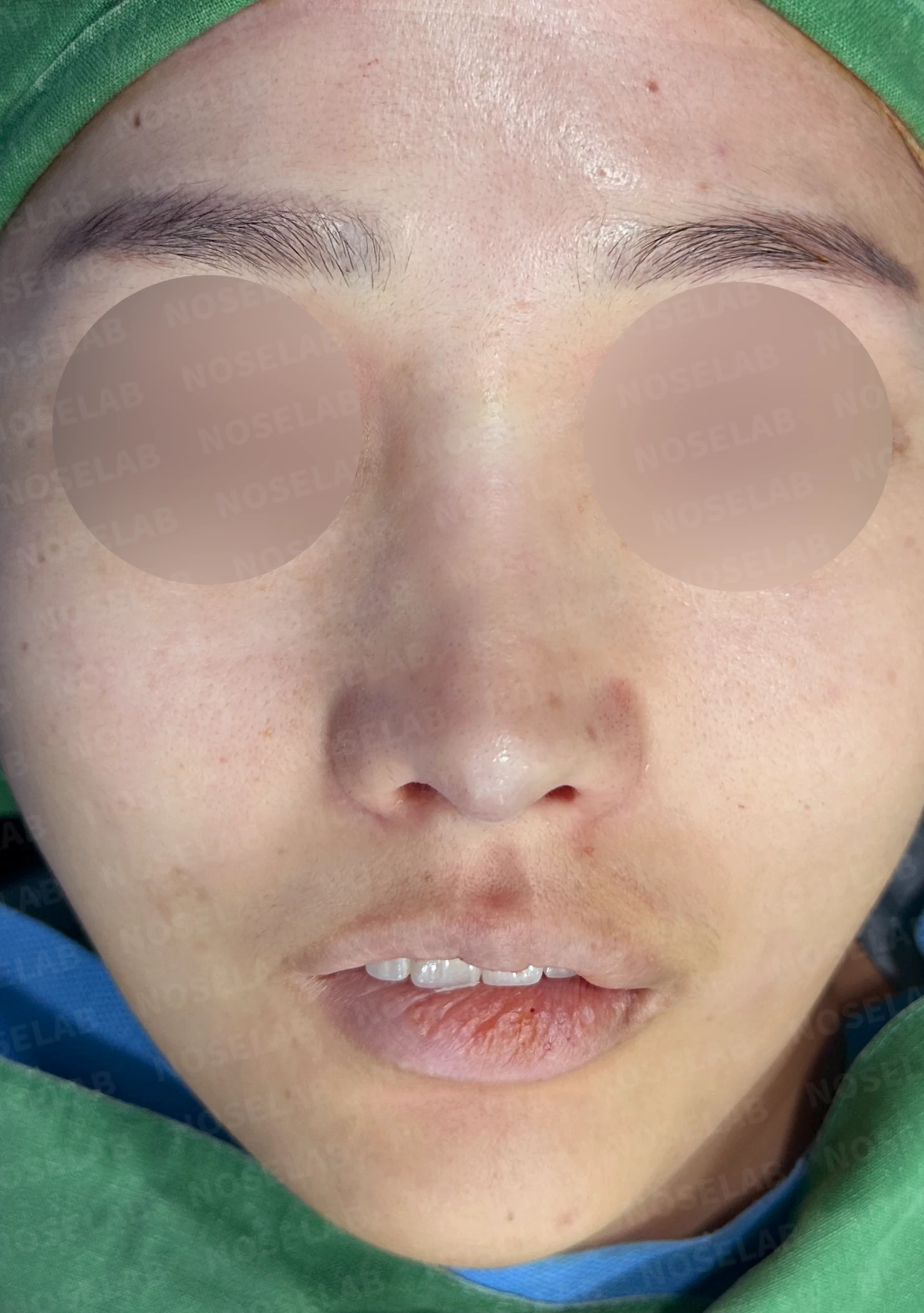 코성형 뒤 코끝이 처져 코가 길어 보이는 이유, 자가늑연골 코끝 재건 방법 — 수술 직후 0일 정면, 비스듬한 측면, 측면 사진입니다. 직후 사진은 부기가 있는 상태로 최종 결과와 다를 수 있습니다.
