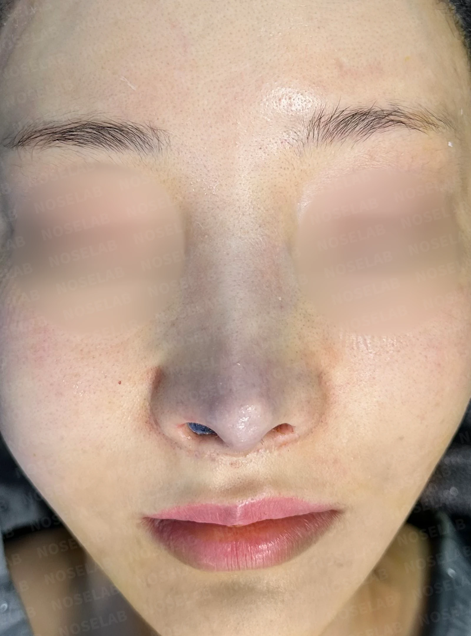 수술 후 14일 조기 교정에서 확인할 점 — 수술 전 / 수술 직후 0일 직후 사진은 부기가 있는 상태로 최종 결과와 다를 수 있습니다.