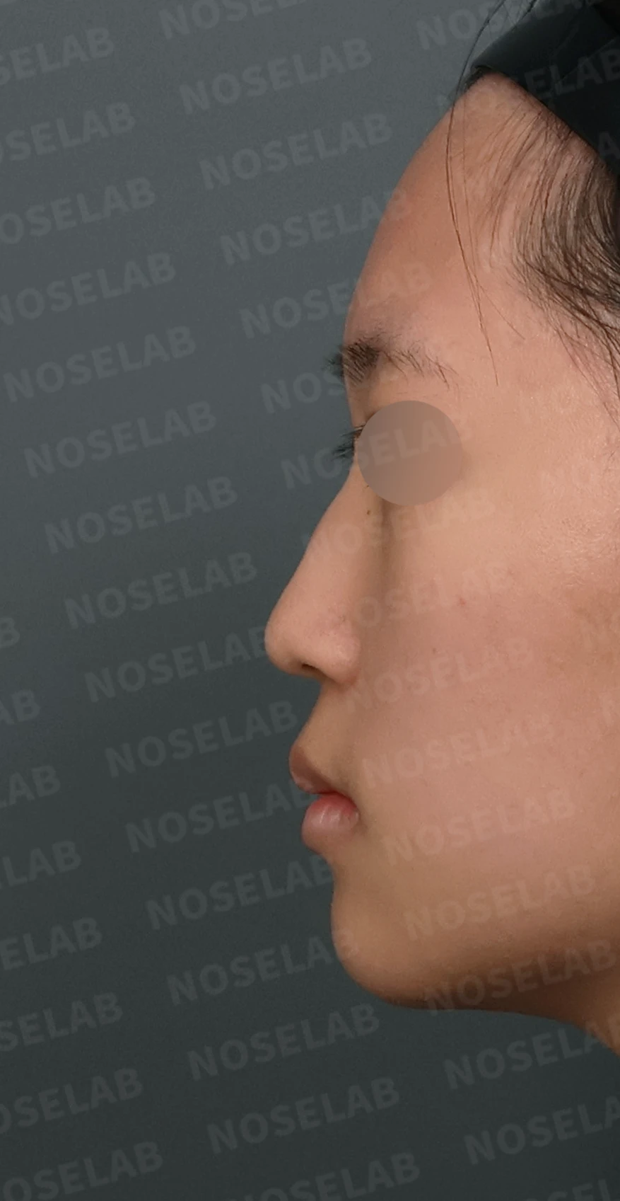 작은 콧날개 연골과 처진 코끝, 자가늑연골과 외측절골술로 자연스럽게 교정 — 디자인 상담 정면, 좌측 측면, 비스듬한 측면 사진입니다.