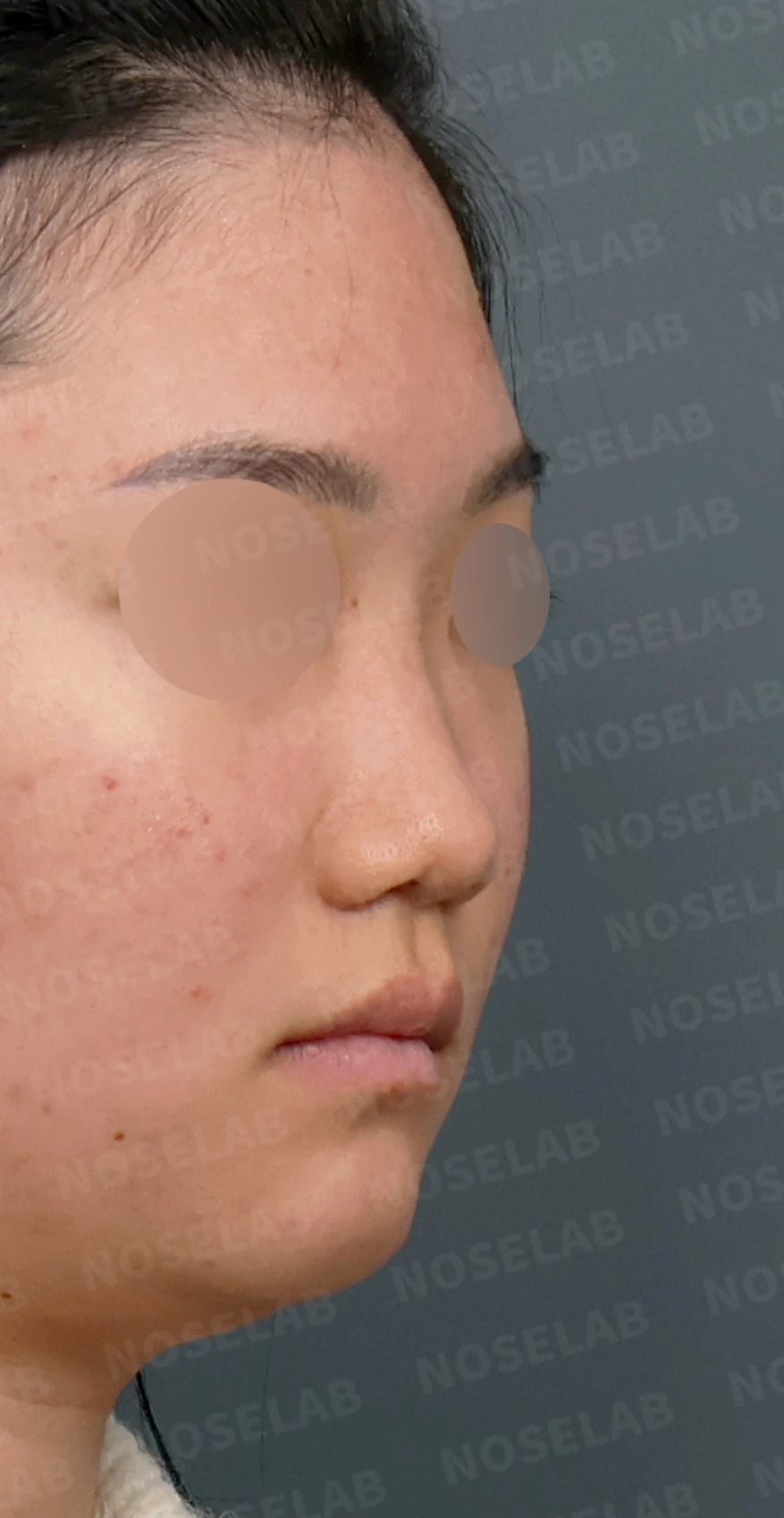 콧대가 낮고 코끝이 뭉툭해 보이는 이유, 함몰된 비주와 함께 교정하는 방법 — 디자인 상담 우측 측면, 비스듬한 측면, 비공 사진입니다.
