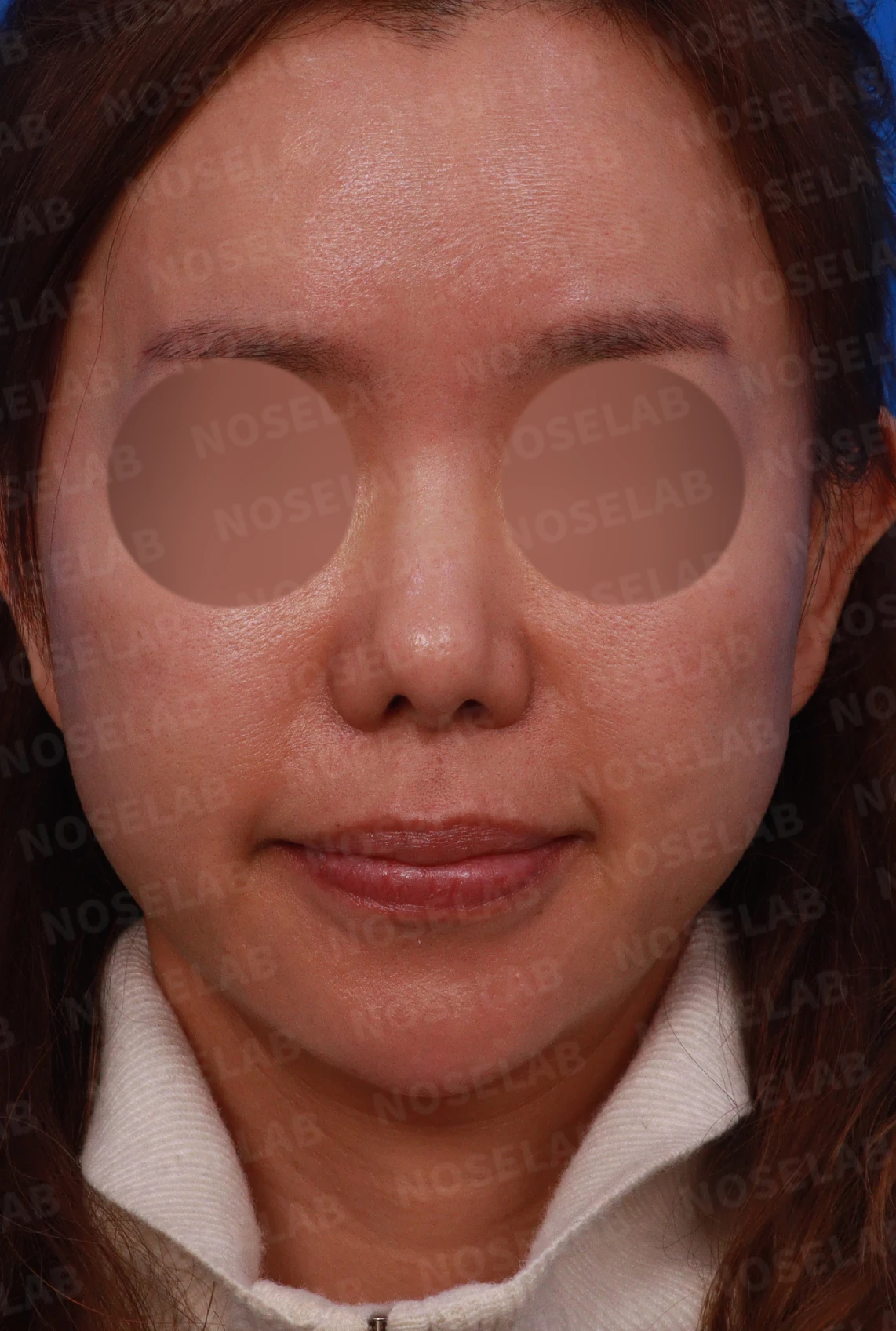 보형물을 제거한 뒤 콧대가 꺼지고 퍼지는 이유, 재건은 어떻게 하나 — 디자인 상담 정면, 좌측 측면, 비스듬한 측면 사진
