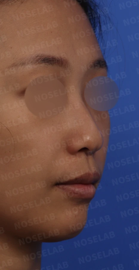 갈라져 보이는 코끝의 구조와 교정 방법 — 본문 사진 6
