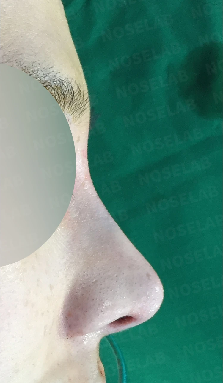 매부리 코·휜 코·뭉툭한 코·콧구멍 비대칭 교정 코 수술 방법 — 본문 사진 2