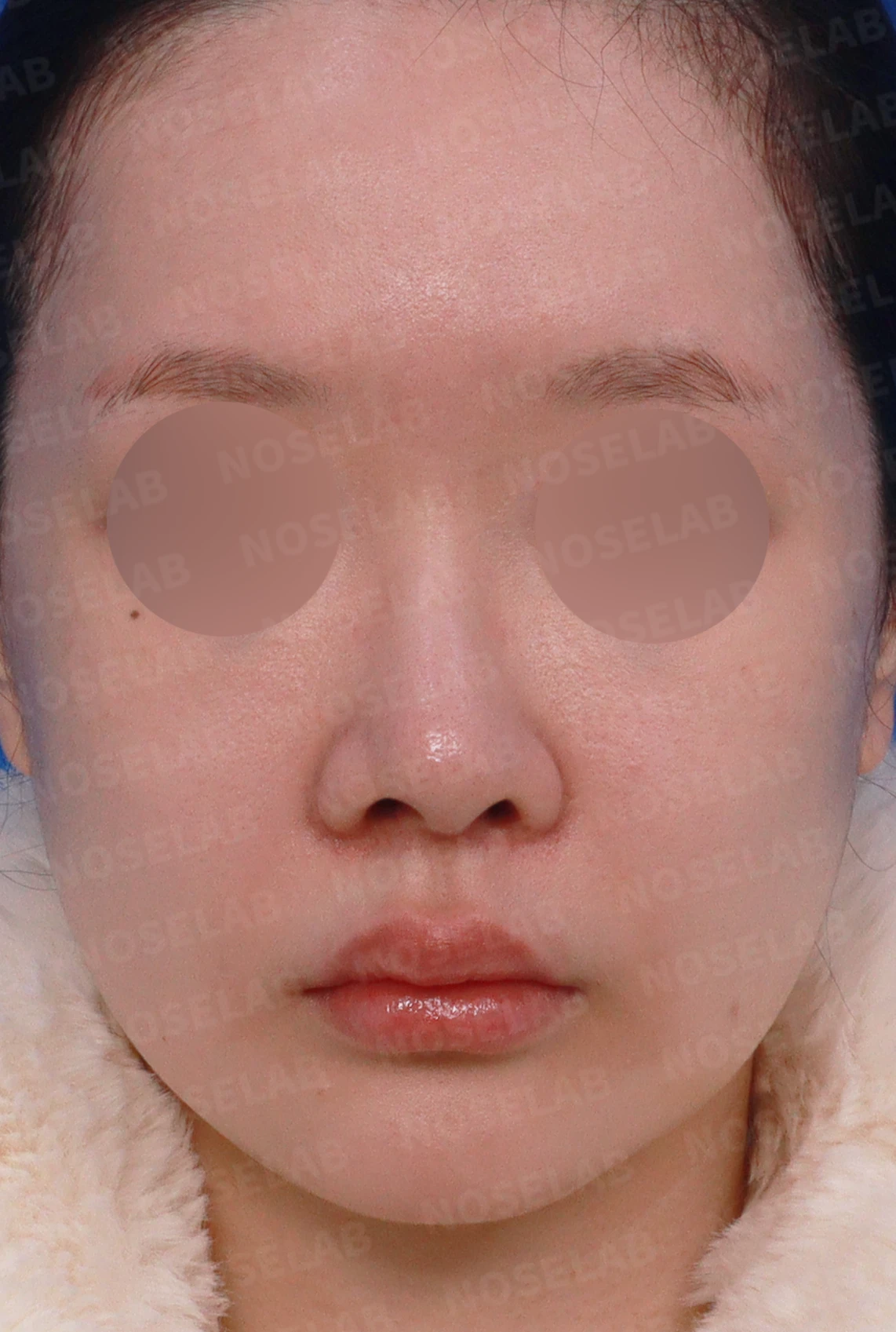 절골 부위가 과하게 깎이면 코가 왜 휘어 보이는가, 코뼈 복원과 코끝 재건 — 디자인 상담 정면, 좌측 측면, 비스듬한 측면 사진입니다