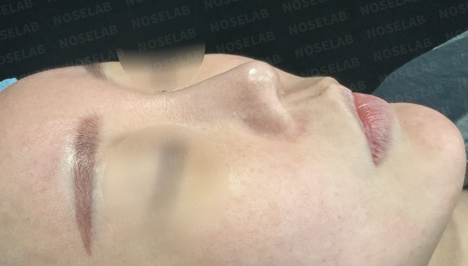 비주 함몰과 복코, 비공 비대칭의 교정 방법 — 수술 전 / 수술 직후 0일 직후 사진은 부기가 있는 상태로 최종 결과와 다를 수 있습니다.