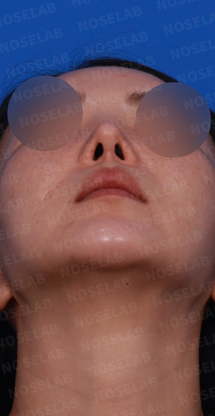 들린 코에서 콧구멍이 삼각형으로 드러나는 이유, 비공 모양 교정은 어떻게 하나 — 디자인 상담 우측 비스듬한 측면, 측면, 비공 사진
