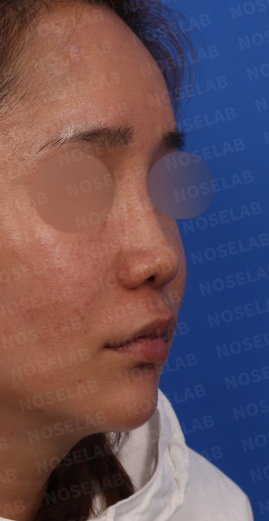 코에 주입된 칼슘필러의 제거와 재건 방법 — 콧대의 휘어짐이 더욱 두드러짐 코끝의 낮음이 확연히 보임 콧구멍 사진: