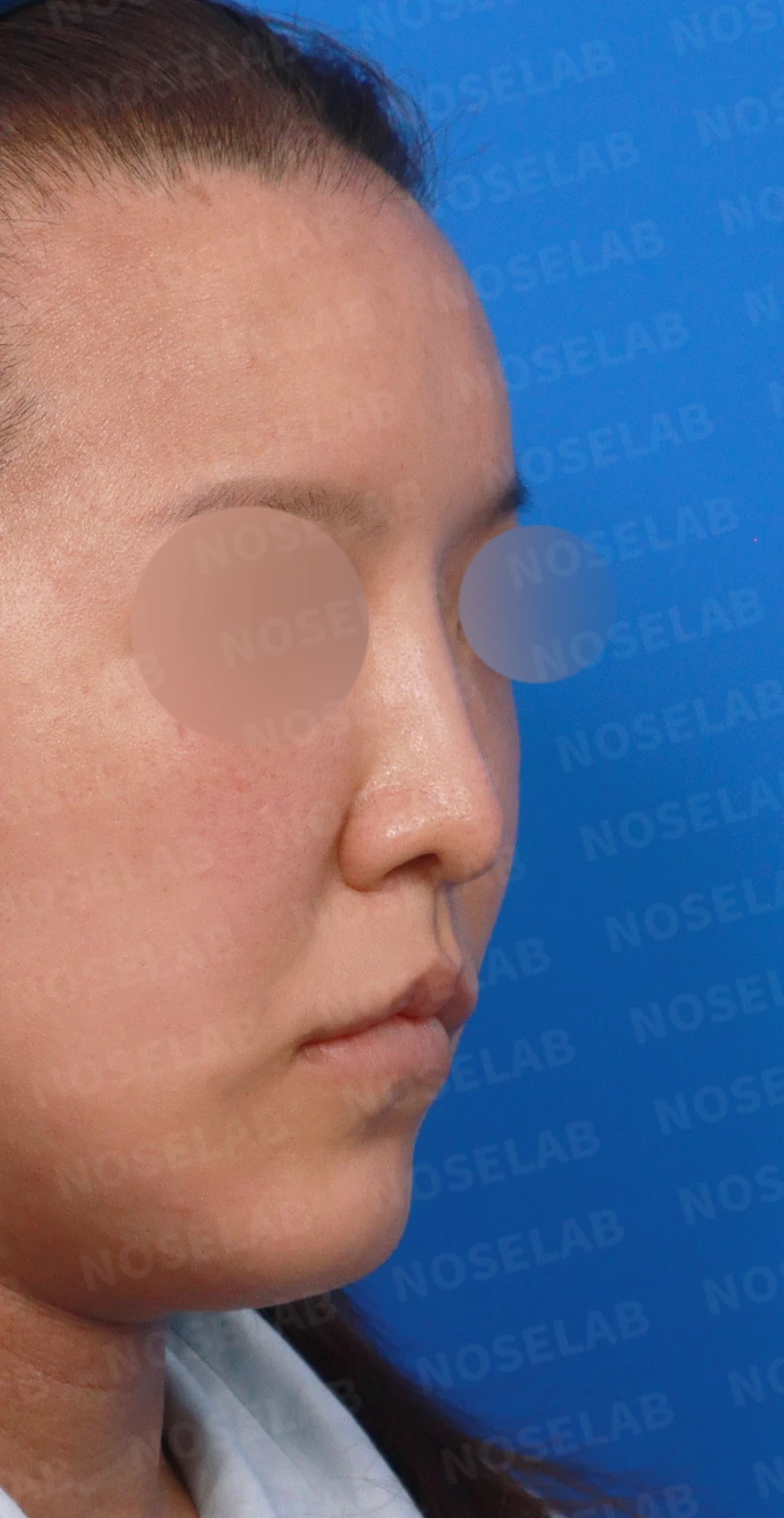 휜 코 교정과 코막힘 개선, 두 마리 토끼를 잡은 성공 사례 — 디자인 상담 우측 측면, 비스듬한 측면, 비공 사진입니다.