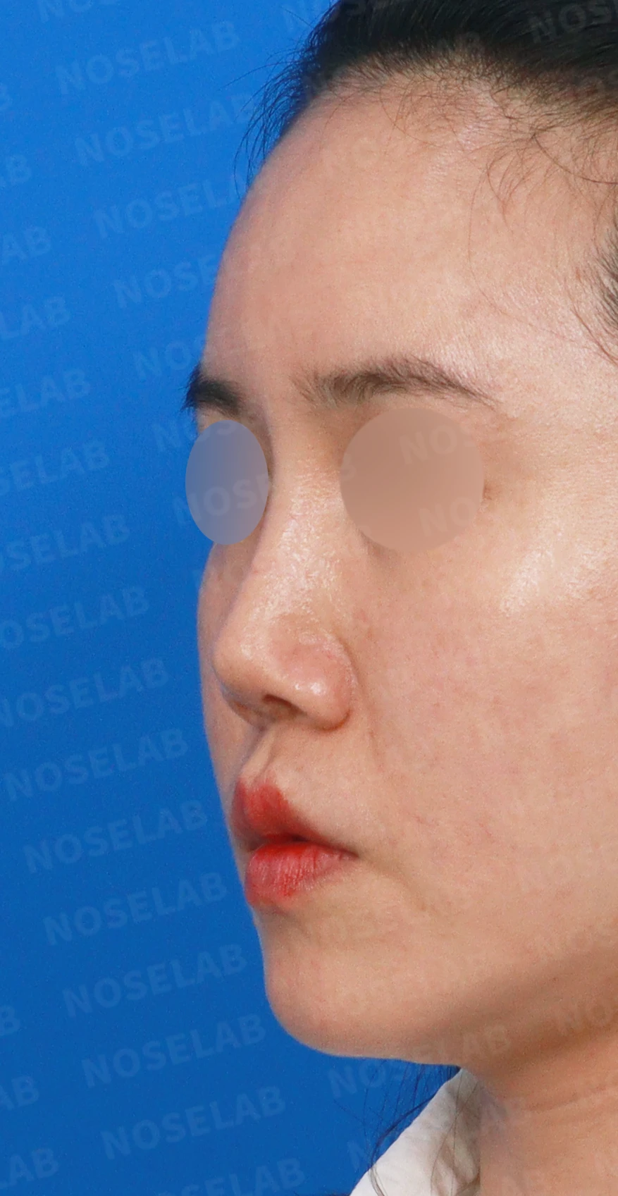 메드포어를 넣은 코에 코막힘이 생기는 이유, 제거와 자가늑연골 비중격 재건은 어떻게 하나 — 디자인 상담 정면, 좌측 측면, 비스듬한 측면 사진입니다.