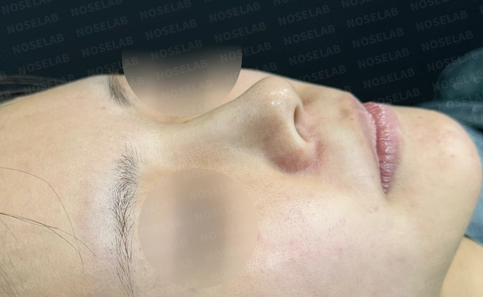 필러 맞고 퍼진 코 교정 방법 — 수술 전 / 수술 직후 0일 직후 사진은 부기가 있는 상태로 최종 결과와 다를 수 있습니다.