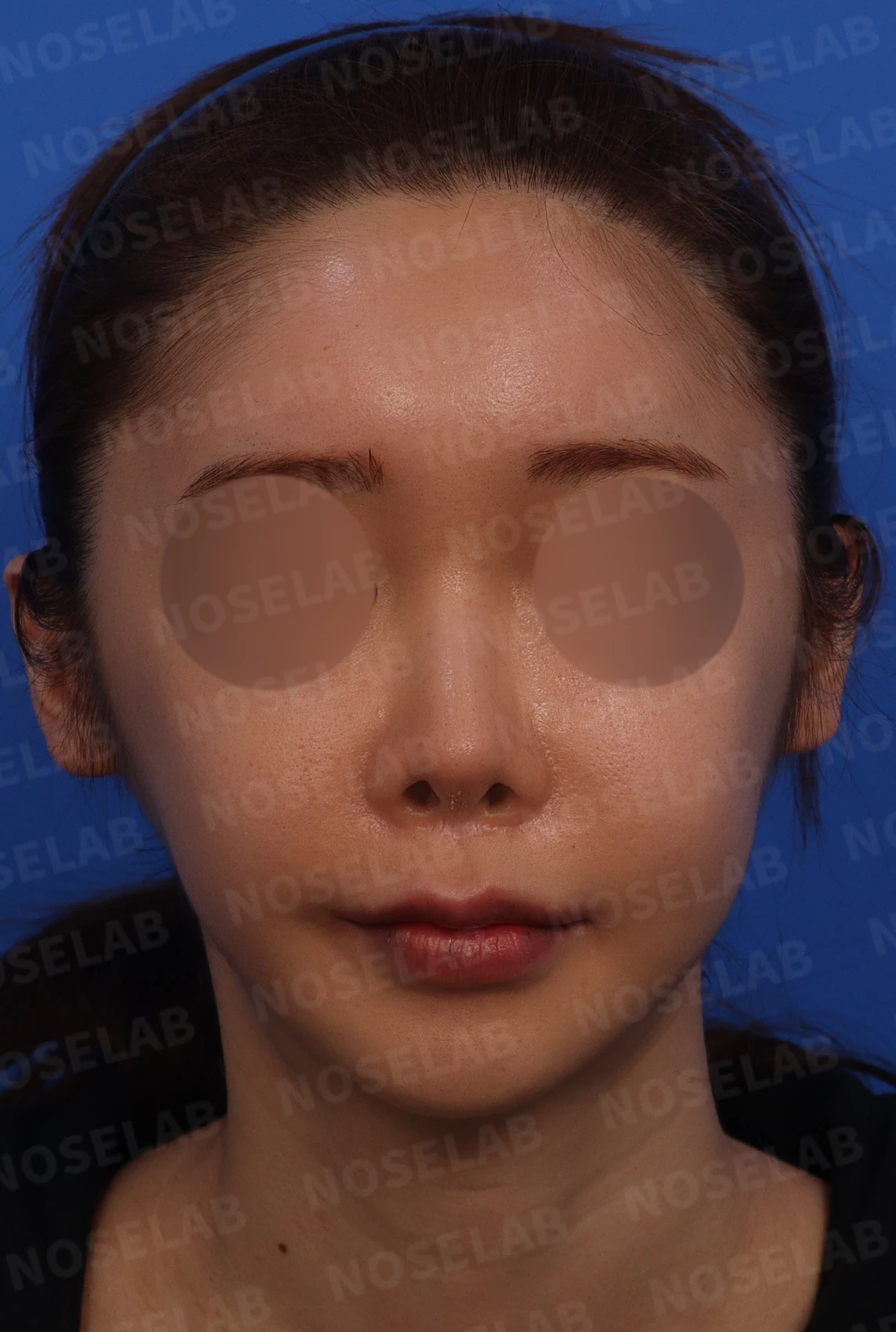 짧고 들린 코교정 방법 — 정면 45도 90도 사진입니다.