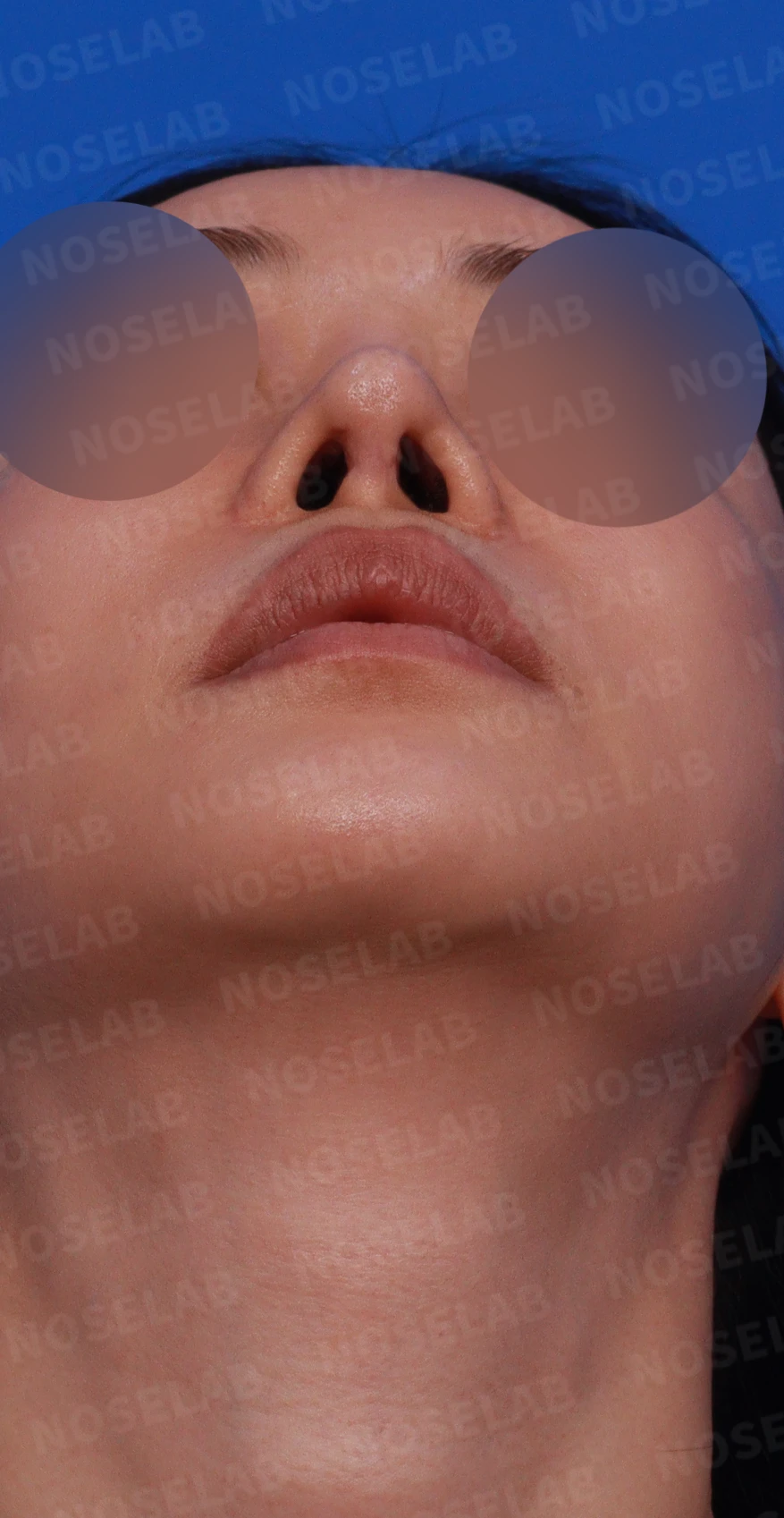 들린코와 시작점 내리고 화려하게 수술사례 — 디자인 상담 우측 측면, 비스듬한 측면, 비공 사진