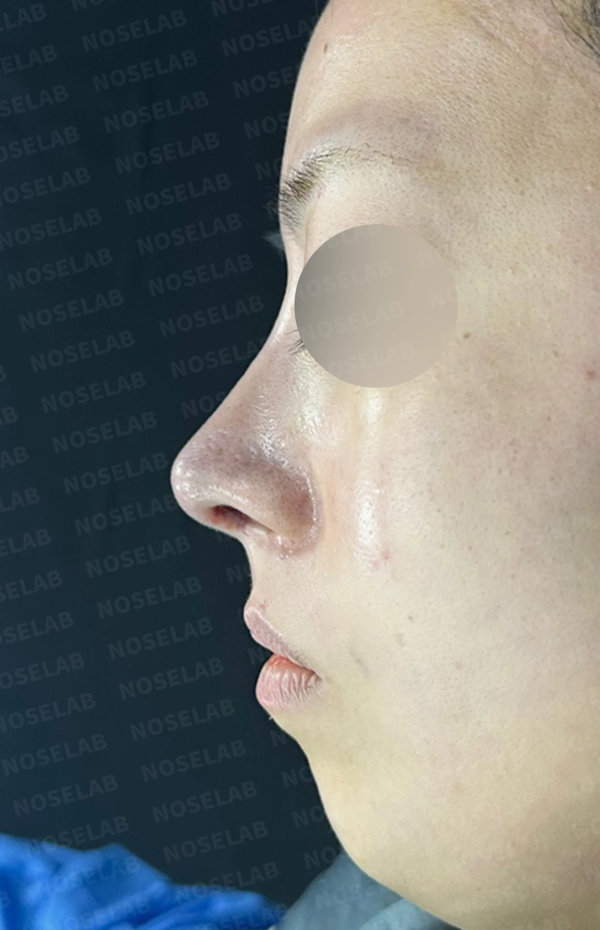 재수술 뒤에도 복코와 퍼진 코끝이 남는 이유, 자가 늑연골 재건은 어떻게 하나 — 수술 직후 0일 정면, 측면, 비스듬한 측면 사진입니다. 직후 사진은 부기가 있는 상태로 최종 결과와 다를 수 있습니다.