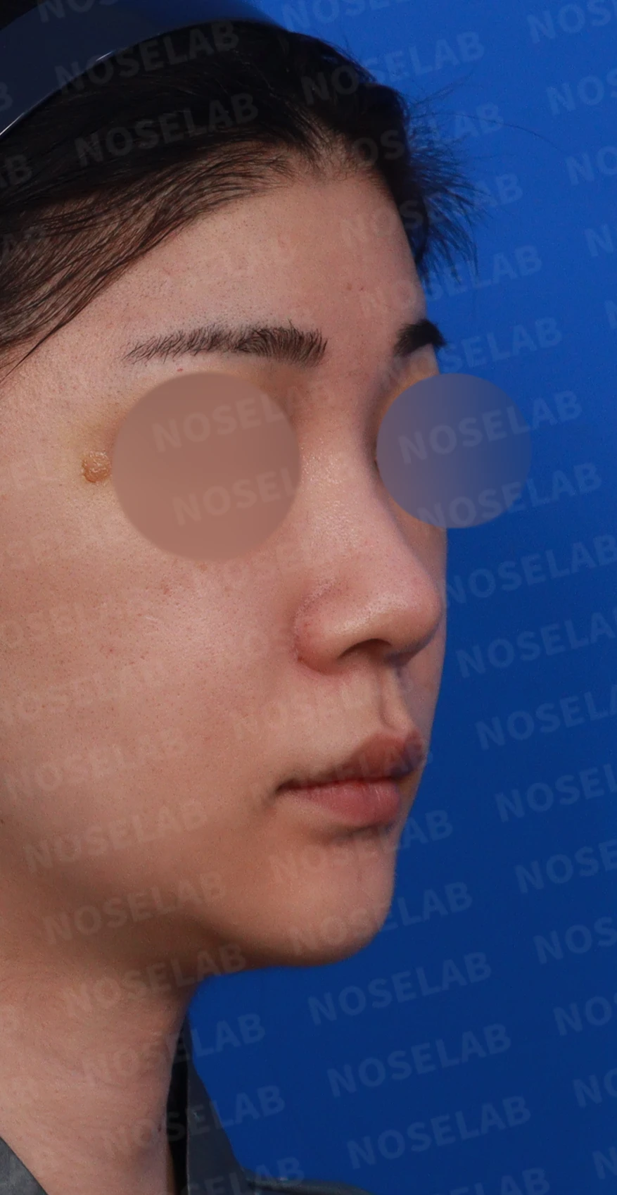 코가 뭉툭하고 퍼져 보이는 이유, 비순각과 비주는 어떻게 교정하나 — 디자인 상담 우측 비스듬한 측면, 측면, 비공 사진