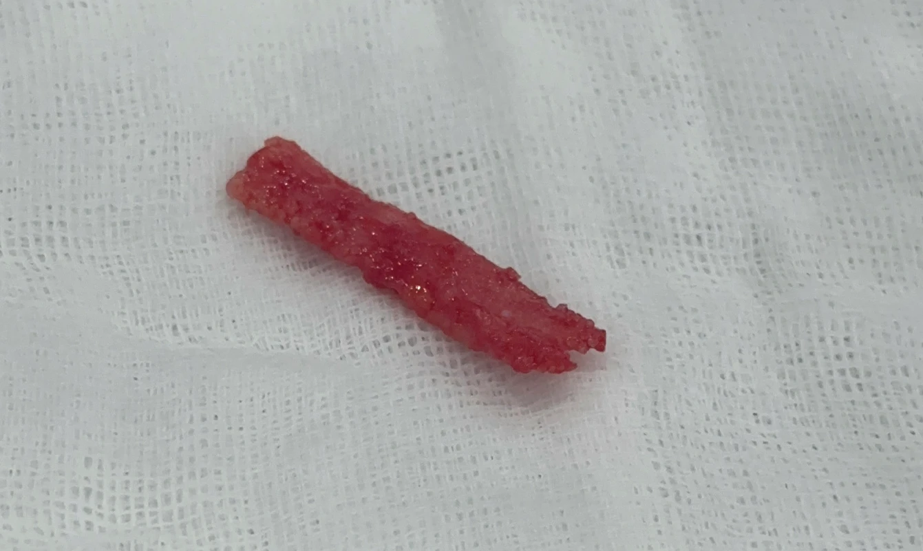 메드포어를 넣은 코에 코막힘이 생기는 이유, 제거와 자가늑연골 비중격 재건은 어떻게 하나 — 제거된 이물질 사진
