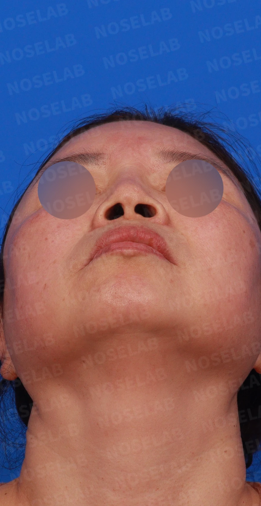 불법 주사 시술 뒤 코가 들리고 짧아지는 이유, 이물질 제거와 재건은 어떻게 하나 — 디자인 상담 우측 비스듬한 측면, 측면, 비공 사진