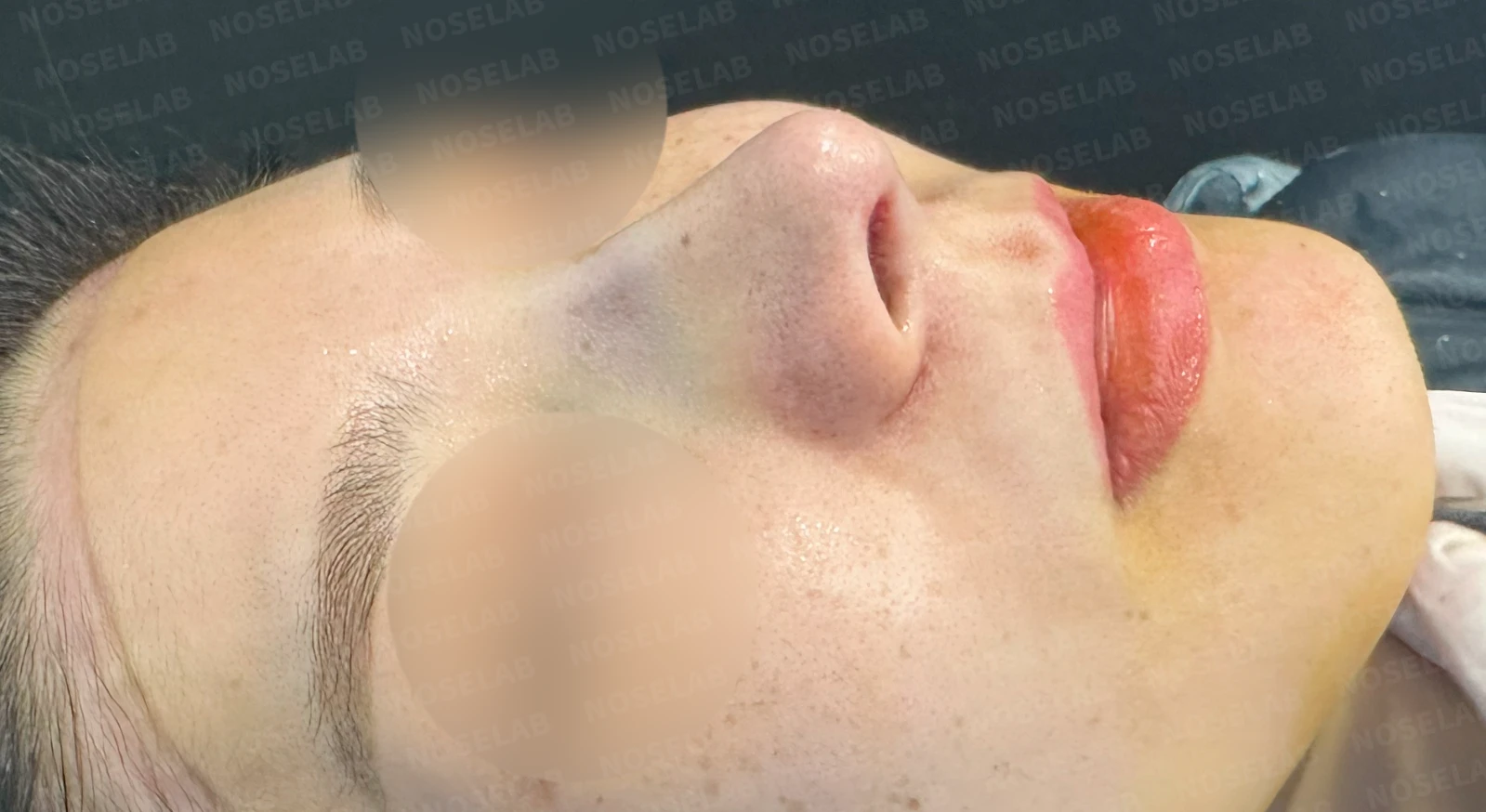 복코, 퍼진코 교정 방법 — 수술 전 / 수술 직후 0일 직후 사진은 부기가 있는 상태로 최종 결과와 다를 수 있습니다.