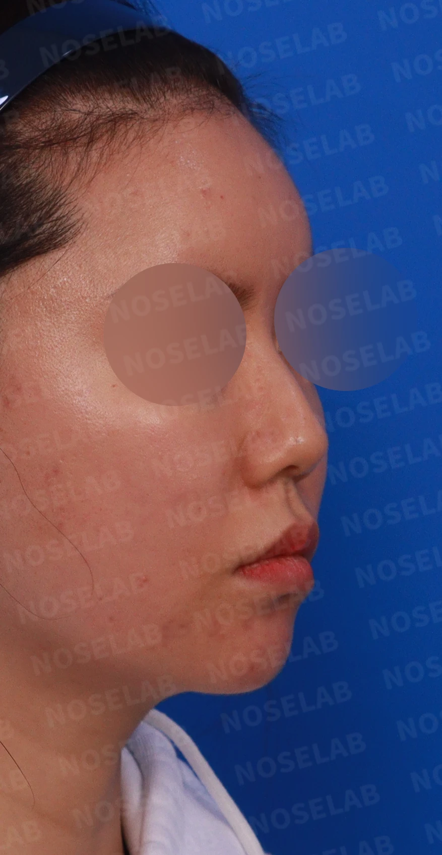 녹지 않고 남은 코 필러와 넓은 콧날개, 원인과 제거·교정 방법 — 디자인 상담 우측 측면 , 비스듬한 측면 , 비공 사진입니다.