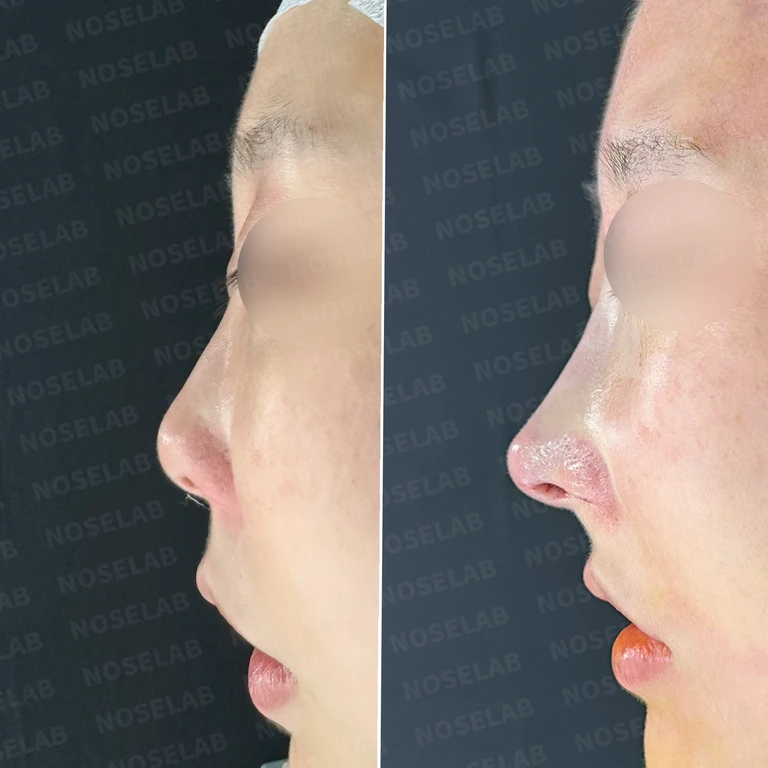 [코성형 후기] 양악수술 후 코막힘 & 퍼진코 교정 - 자연스러운 코라인 만들기 — 전후 비교