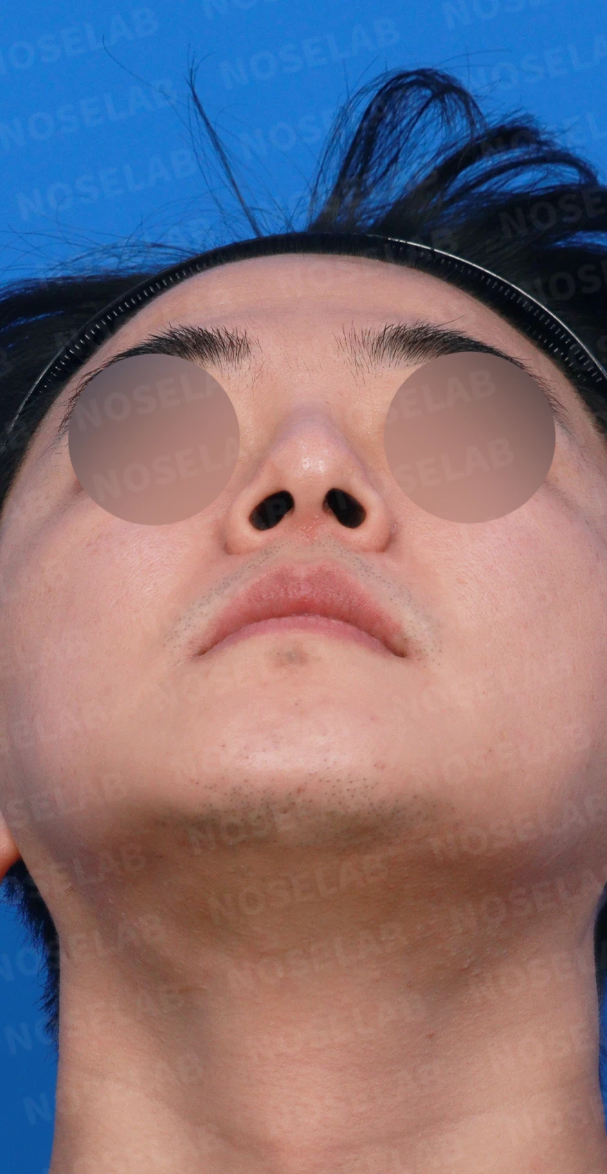 안면 비대칭이 있는 코를 교정할 때 얼굴 축을 먼저 보는 이유 — 디자인 상담 우측 측면, 비스듬한 측면, 비공 사진입니다.