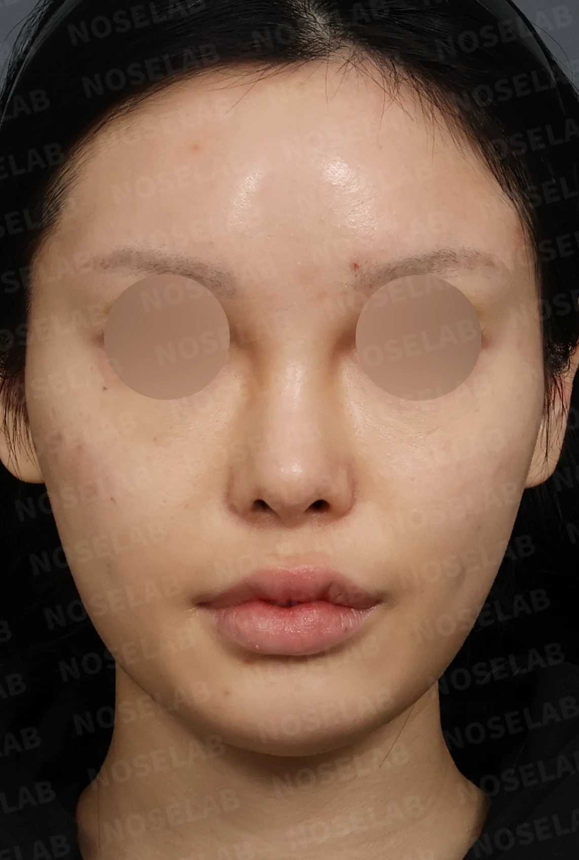 심한 비중격 만곡과 높은 콧대 시작점, 기증늑연골로 정밀 재건 — 디자인 상담 정면, 좌측 측면, 비스듬한 측면 사진입니다.
