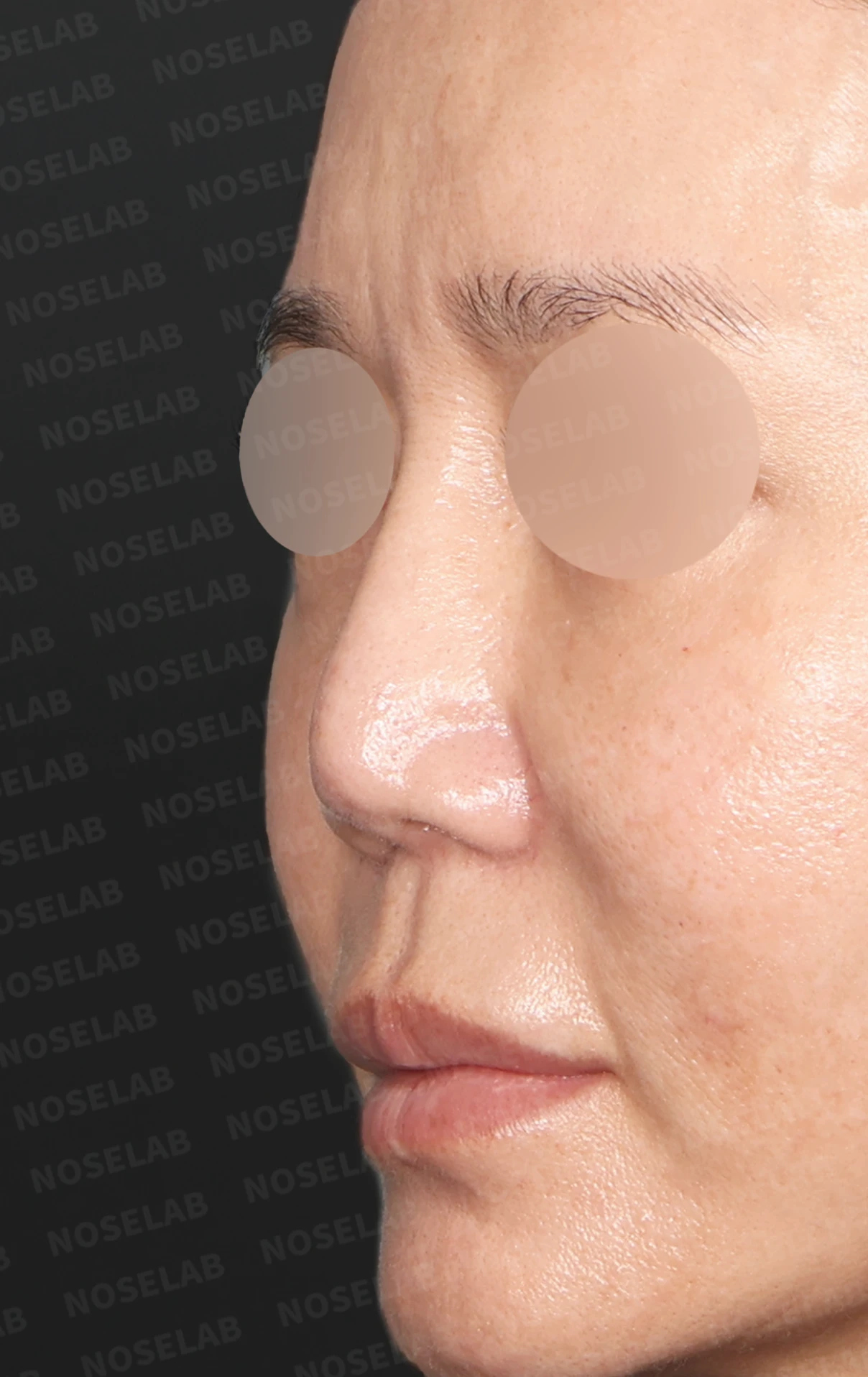 실리콘 재수술, 자가늑연골로 안전하게 코 라인 교정한 사례 — 전(좌) 직후(후)