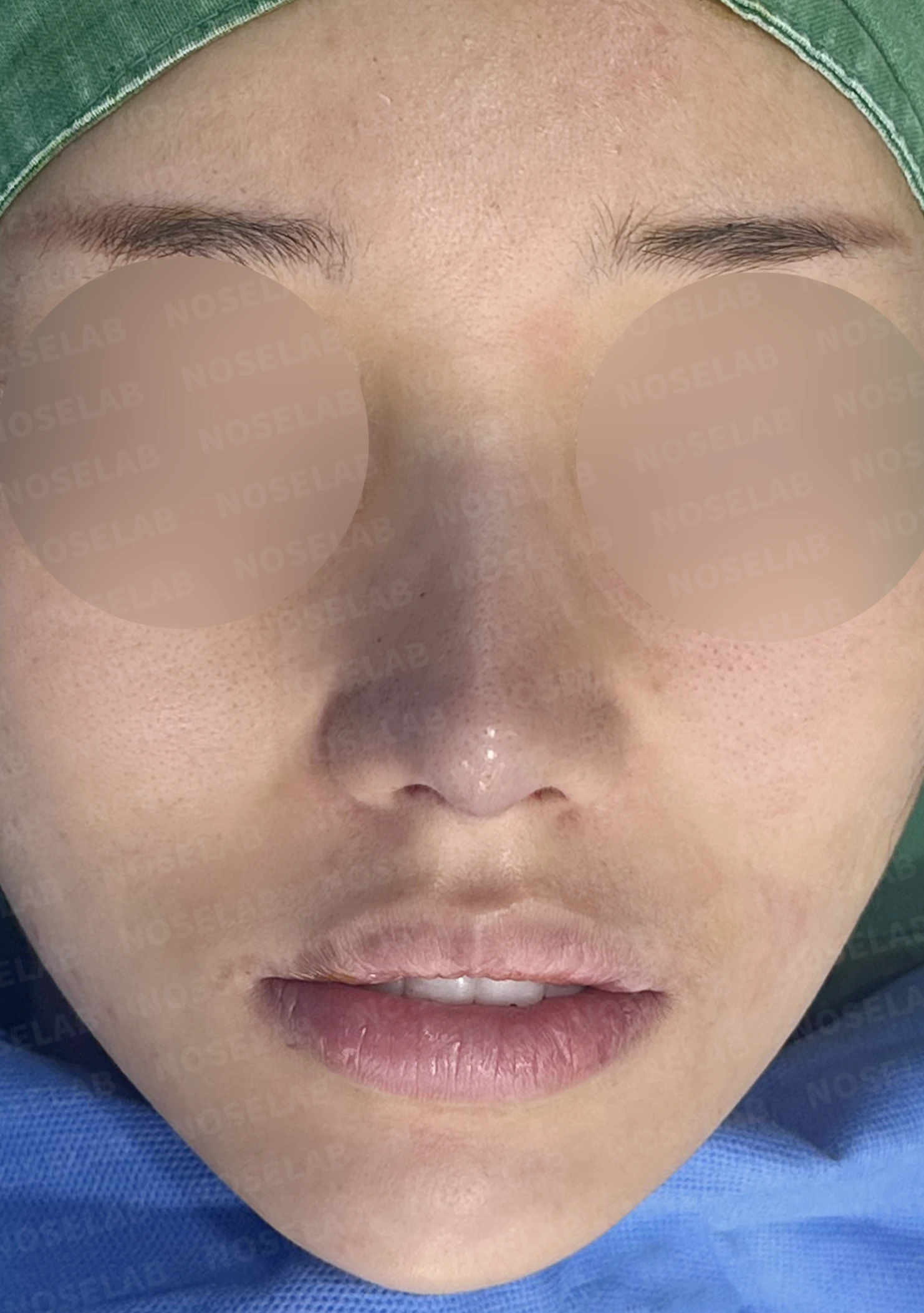 코끝 연골이 피부로 비쳐 보이는 이유와 진피 보강 방법 — 수술 직후 0일 정면, 비스듬한 측면, 측면 사진입니다. 직후 사진은 부기가 있는 상태로 최종 결과와 다를 수 있습니다.