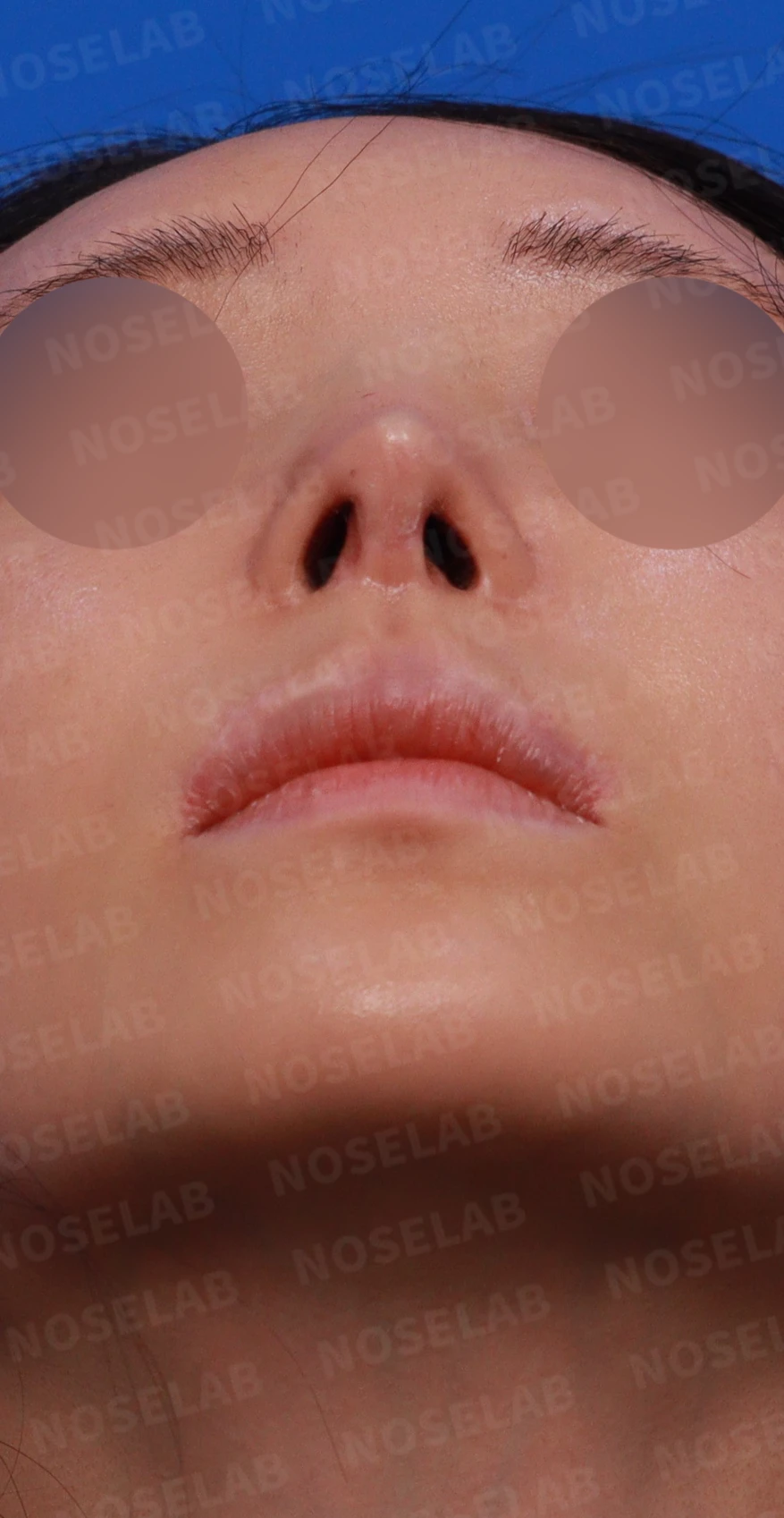 뾰족한 코끝과 연골 비침의 교정 방법 — 디자인 상담 우측 측면, 비스듬한 측면, 비공 사진입니다.