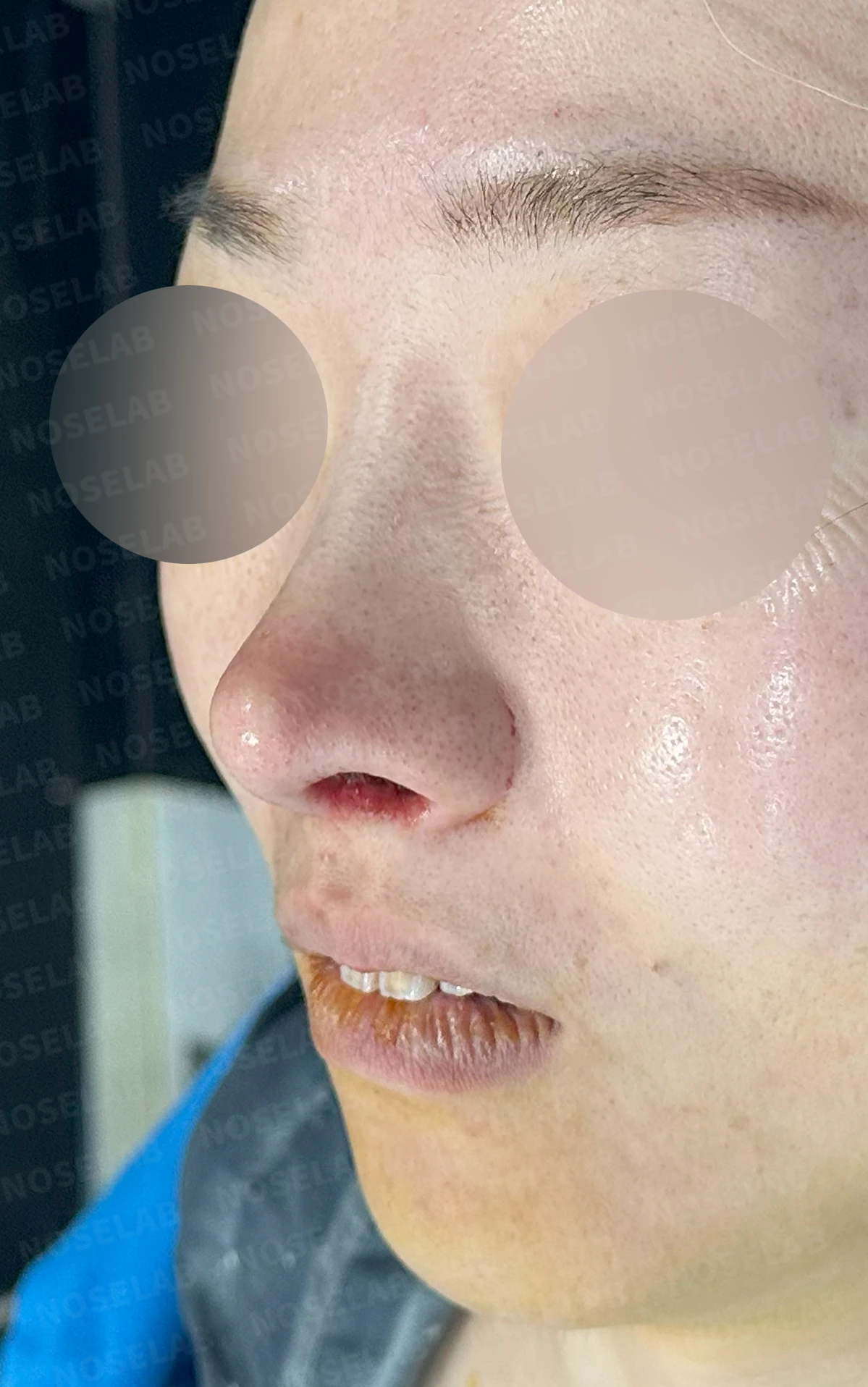 콧볼 축소 뒤 코가 뭉툭하고 길어 보이는 이유, 어떻게 교정하나 — 수술 직후 0일 정면, 비스듬한 측면, 측면 사진 직후 사진은 부기가 있는 상태로 최종 결과와 다를 수 있습니다.