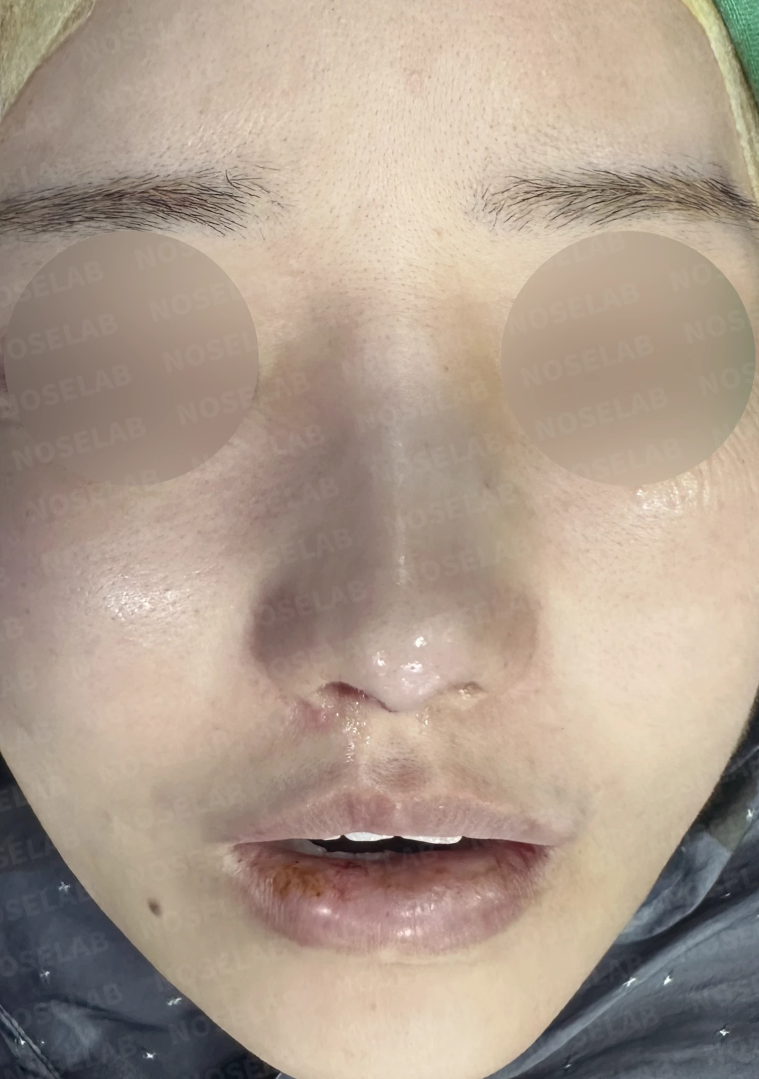 짧고 들린 코, 자가늑연골로 비중격 재건한 코재수술 사례 — 직후 정면 , 비스듬한 측면 , 측면 사진 입니다.