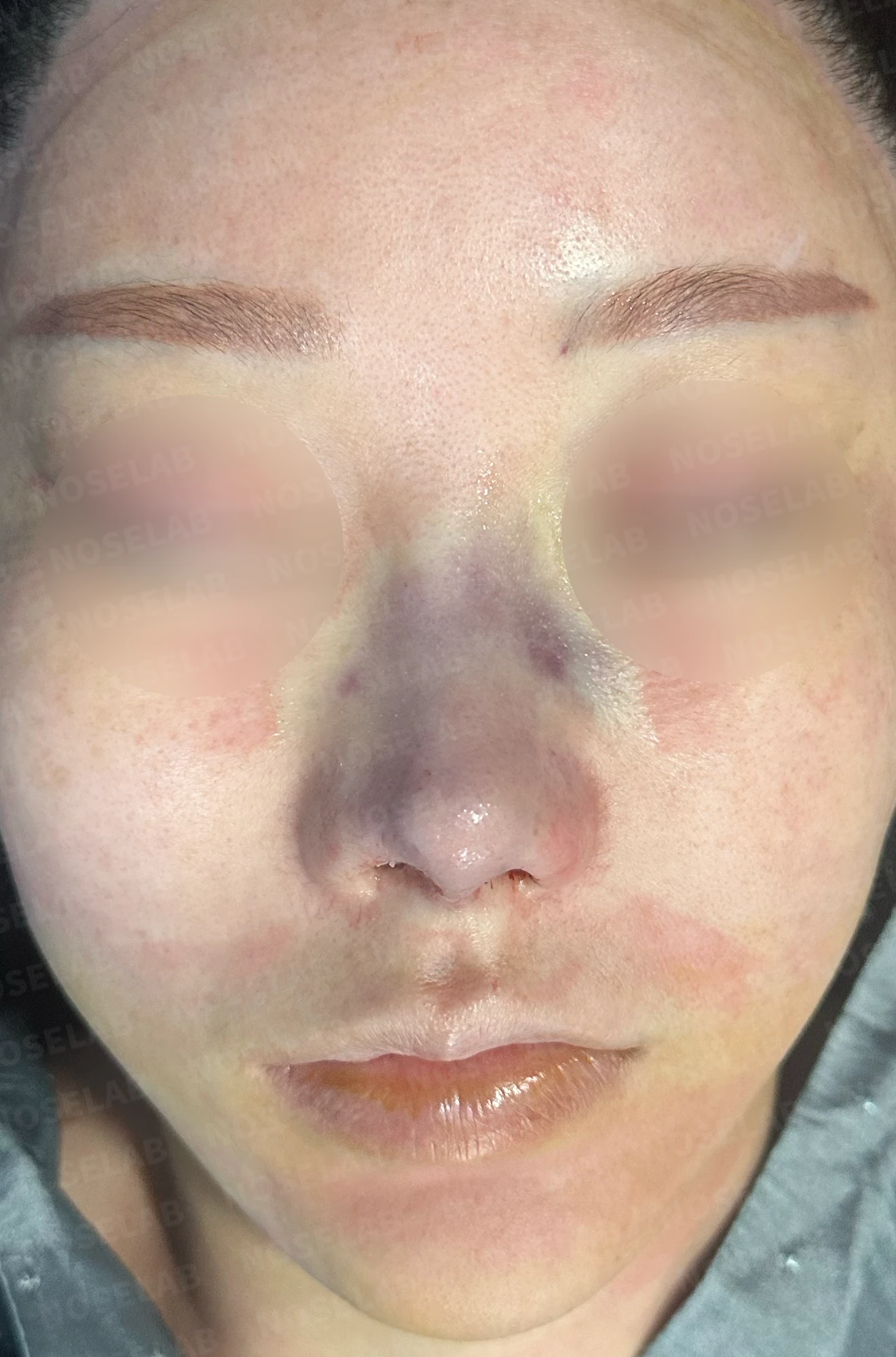 비주 함몰과 복코, 비공 비대칭의 교정 방법 — 수술 전 / 수술 직후 0일 직후 사진은 부기가 있는 상태로 최종 결과와 다를 수 있습니다.