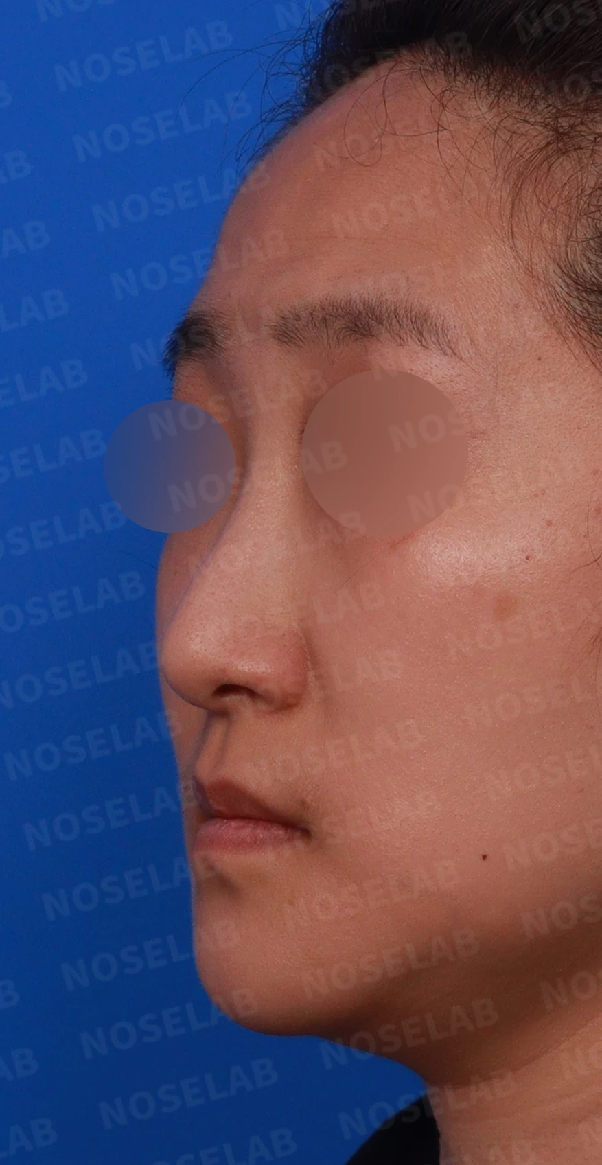 코가 한쪽으로 휘어 보이고 밤에 막히는 이유, 비중격 재건과 코막힘 개선 — 디자인 상담 정면 , 좌측 비스듬한 측면 , 측면 사진입니다.