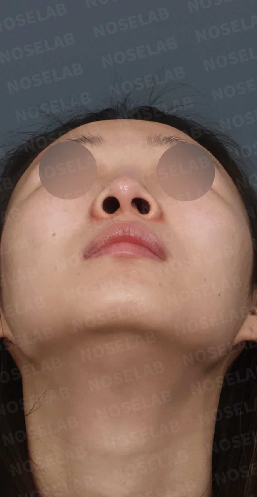 길고 처진 코, 휜코 교정과 코막힘까지 한 번에 해결한 재수술 사례 — 디자인 상담 우측 측면, 비스듬한 측면, 비공 사진입니다.