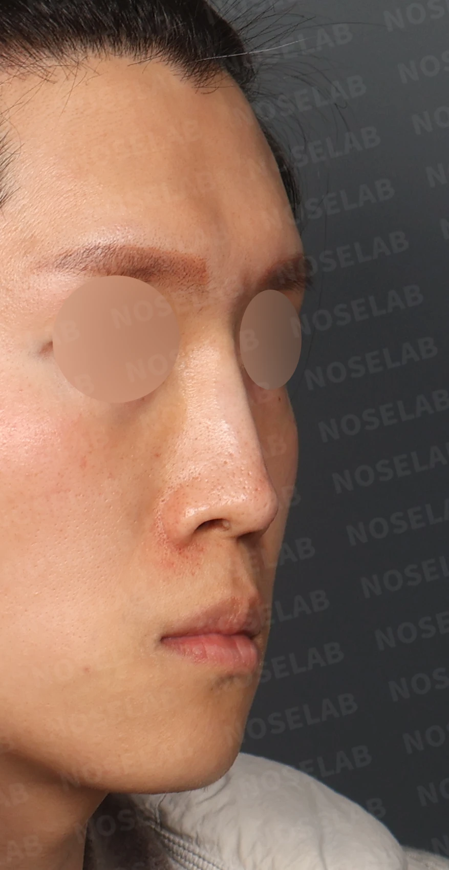 2차 코재수술, 자가늑연골로 비중격 재건과 직선 코 라인 완성 — 디자인 상담 우측 측면, 비스듬한 측면, 비공 사진