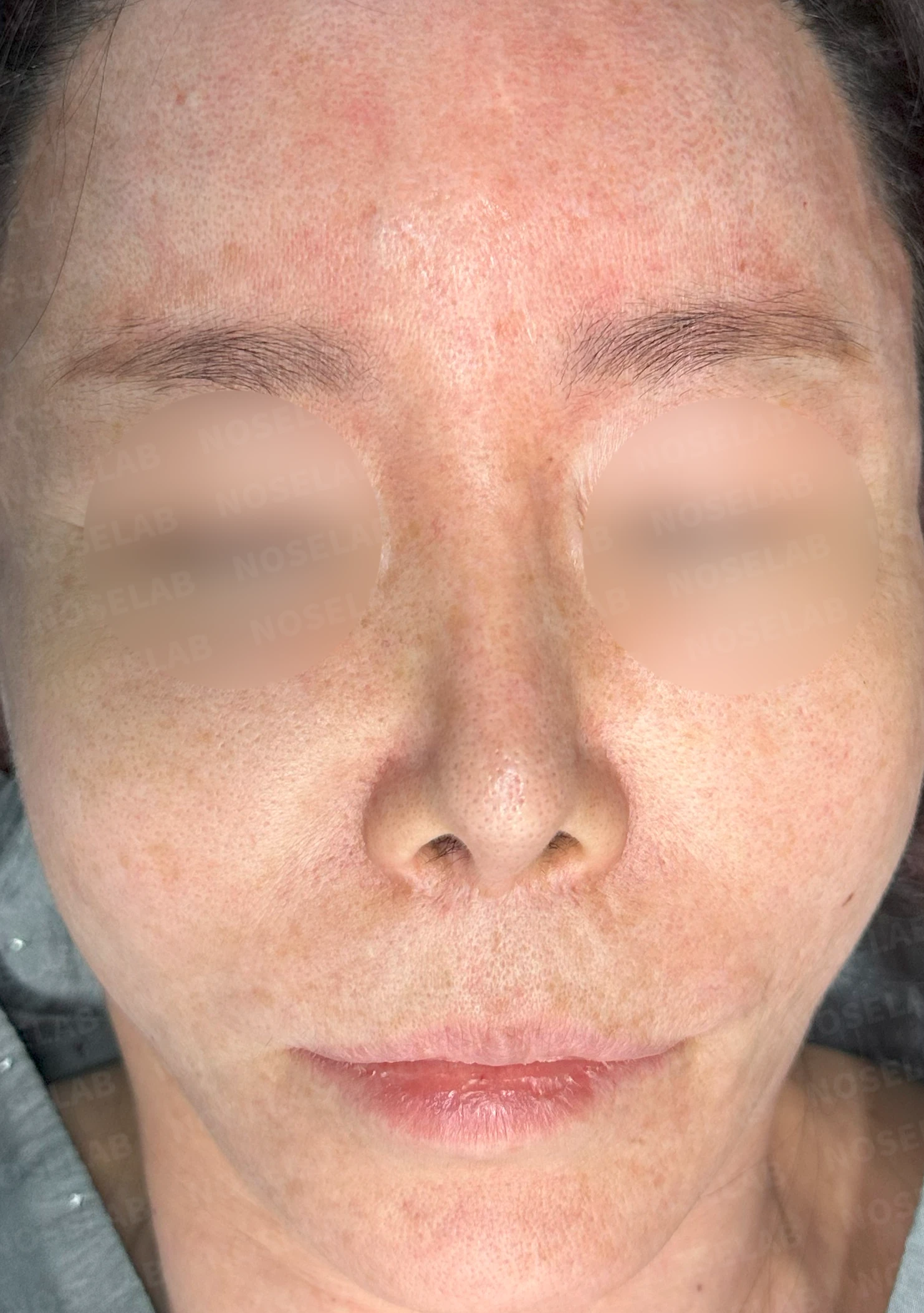 찝힌코, 들린코 자가늑연골 재건으로 교정 사례 — 전(좌) 직후(우)