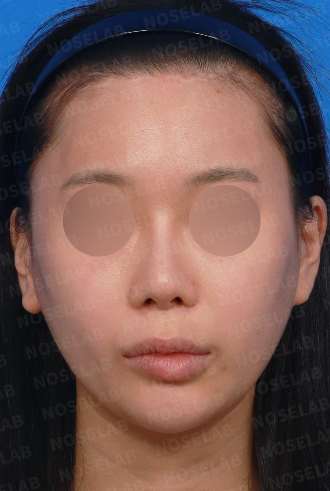 비중격 천공이 생기면 무엇이 문제이고 어떻게 재건하나 — 디자인 상담 정면, 좌측 측면, 비스듬한 측면 사진입니다.