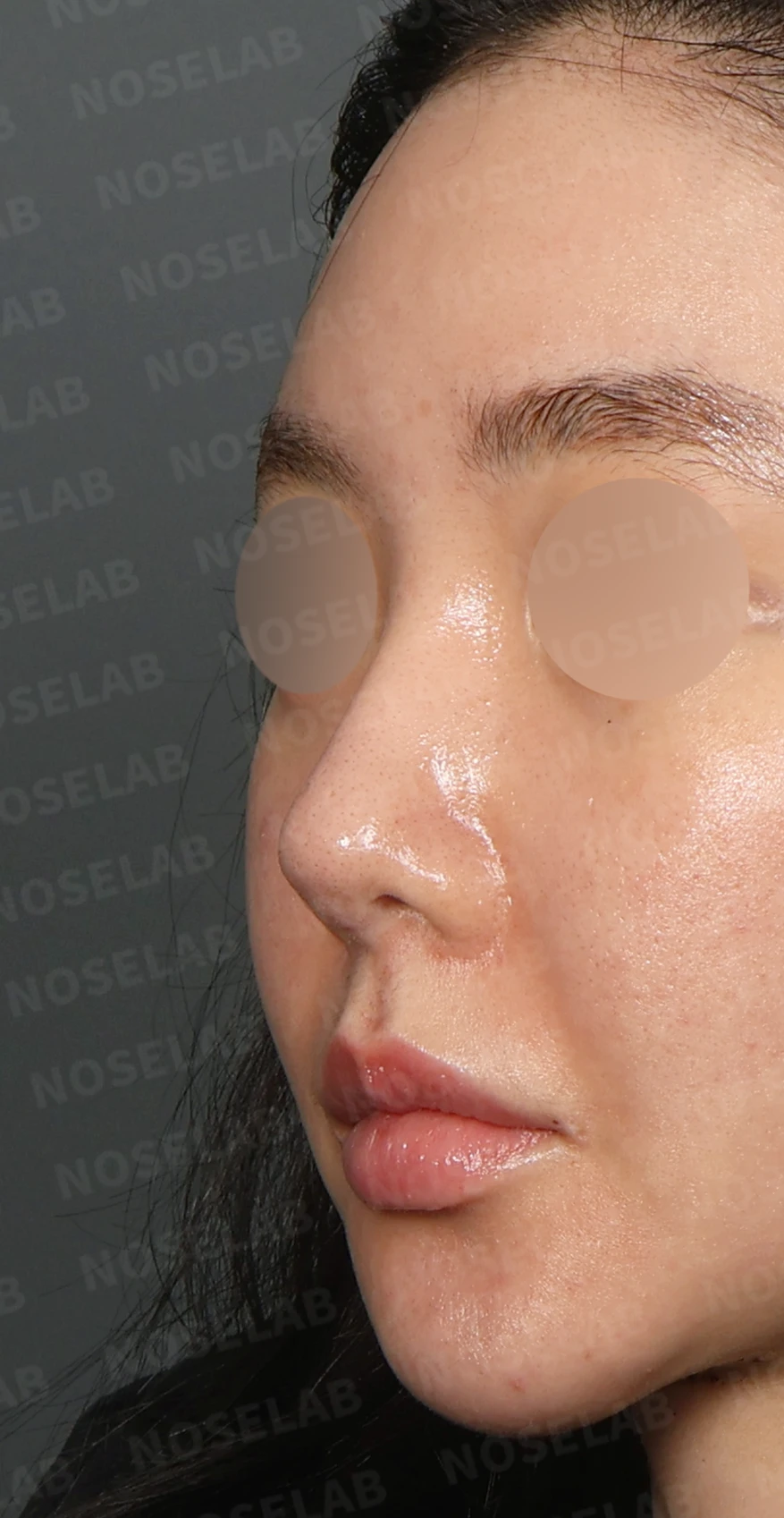 이물질 제거와 자가늑연골 비중격 재건, 들린 코 교정한 코재수술 — 디자인 상담 정면, 좌측 측면, 비스듬한 측면 사진입니다.