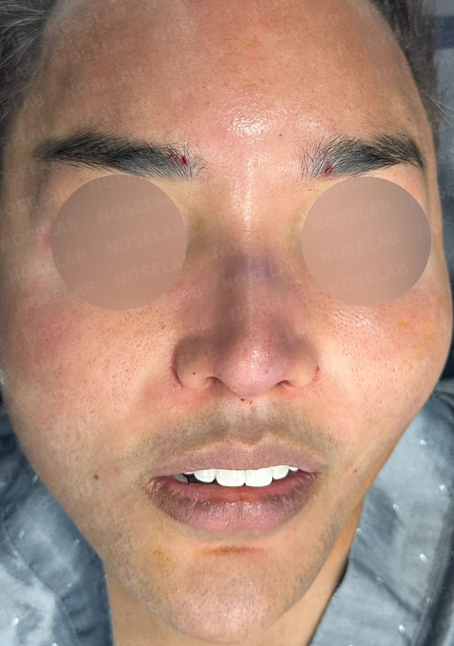 코가 퍼져 보이면서 코막힘이 함께 오는 이유, 절골과 자가 늑연골 교정 방법 — 수술 직후 0일 정면, 측면, 비스듬한 측면 사진 직후 사진은 부기가 있는 상태로 최종 결과와 다를 수 있습니다.