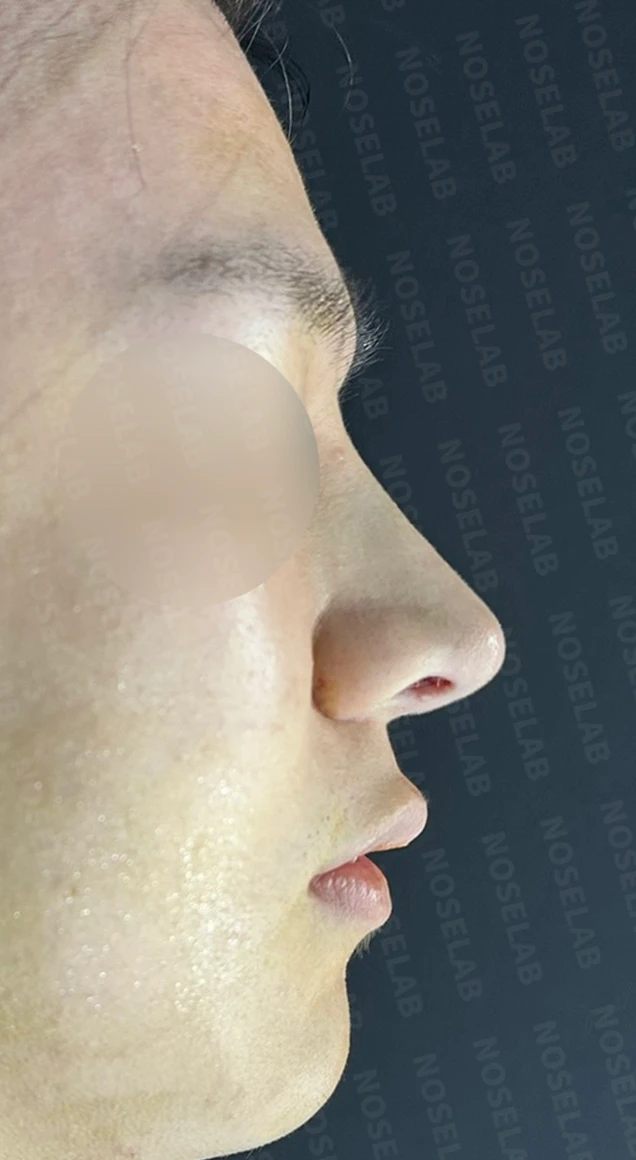 코막힘과 복코를 함께 살펴보는 교정 방법 — 수술 직후 0일 정면, 측면, 비스듬한 측면 사진 직후 사진은 부기가 있는 상태로 최종 결과와 다를 수 있습니다.