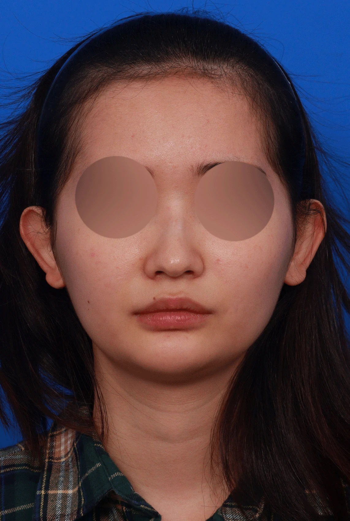 웃을 때만 화살코가 되는 이유와 코끝 연골 교정 방법 — 디자인 상담 정면, 좌측 측면, 비스듬한 측면 사진입니다.