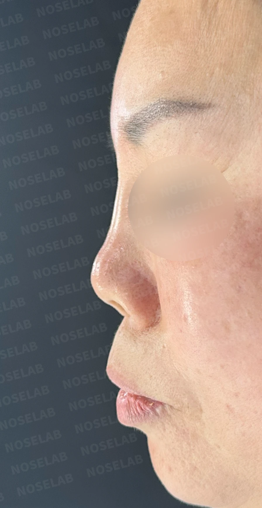 불법 주사 시술 뒤 코가 들리고 짧아지는 이유, 이물질 제거와 재건은 어떻게 하나 — 수술 전 / 수술 직후 0일 직후 사진은 부기가 있는 상태로 최종 결과와 다를 수 있습니다.