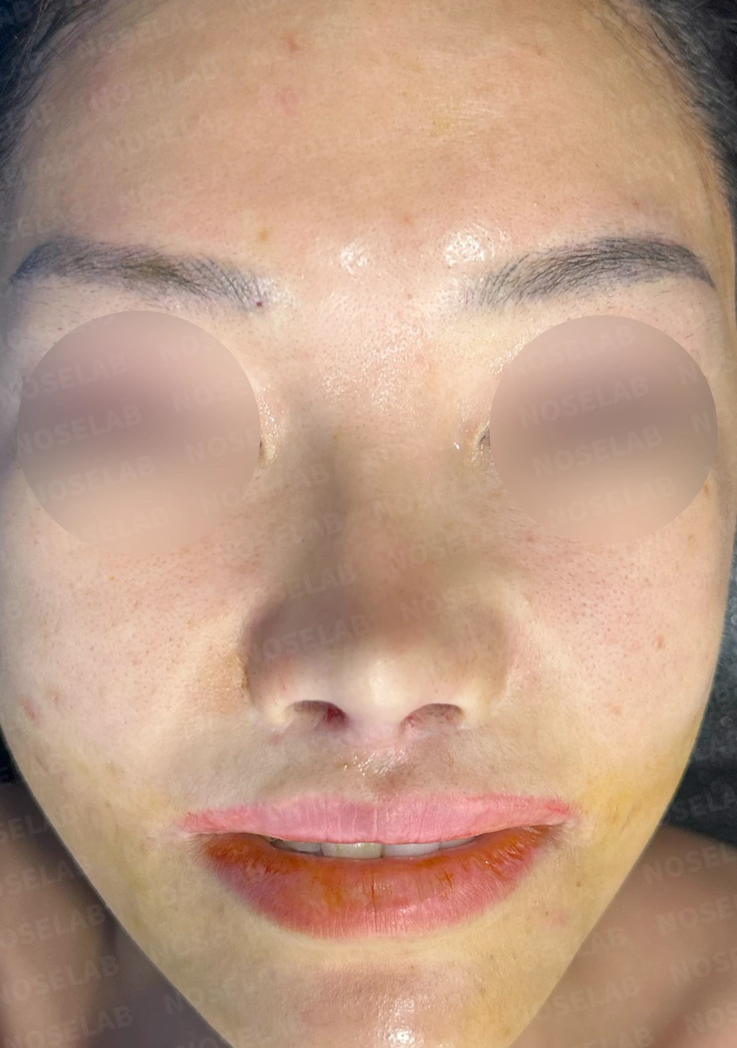 원하는 코 모양과 현재 구조를 함께 살펴보는 수술 계획 — 수술 전 / 수술 직후 0일 직후 사진은 부기가 있는 상태로 최종 결과와 다를 수 있습니다.