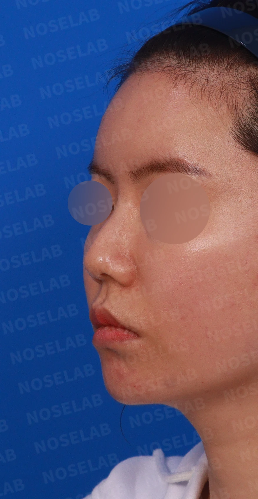 녹지 않고 남은 코 필러와 넓은 콧날개, 원인과 제거·교정 방법 — 디자인 상담 정면 , 좌측 측면 ,비스듬한 측면 사진입니다.