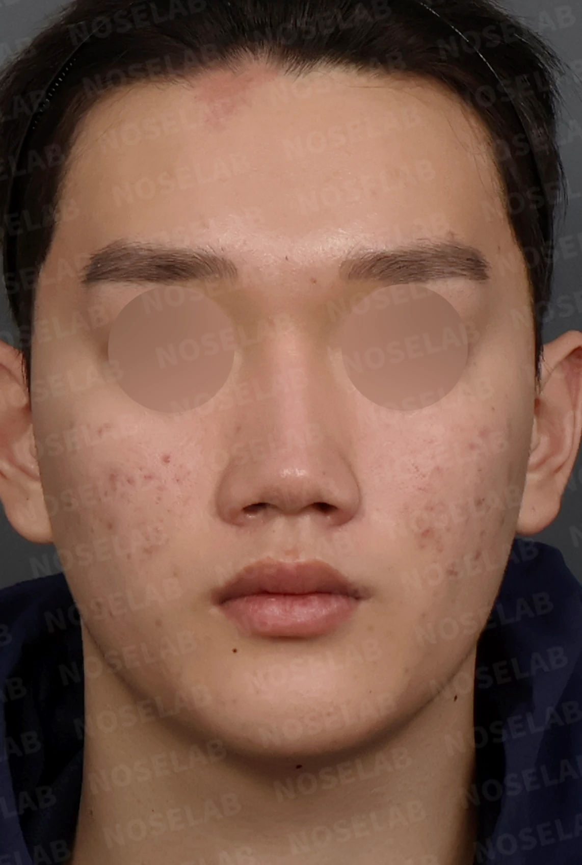 휜코 매부리코 교정, 남자 코성형으로 자연스러운 변화 — 디자인 상담 정면, 좌측 측면, 비스듬한 측면 사진입니다.
